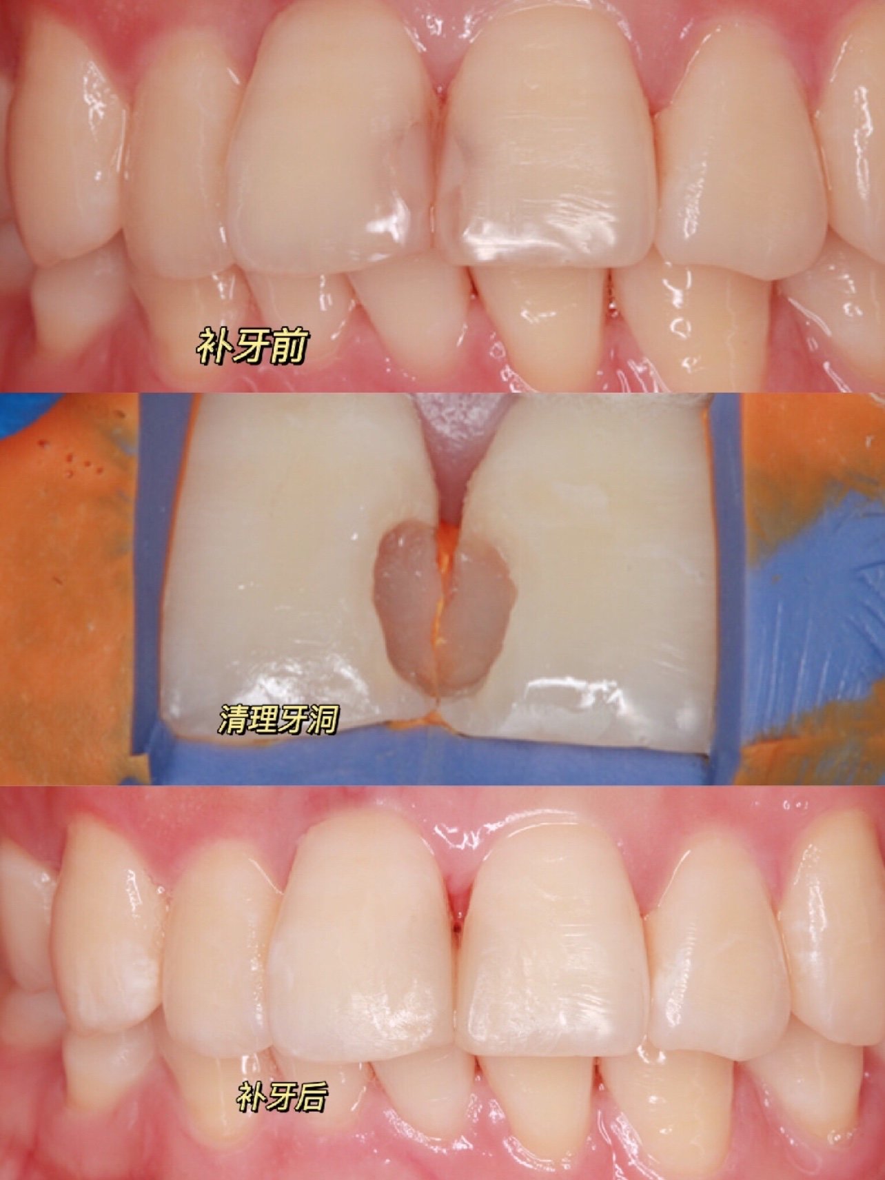 补牙日记分享补牙会不会痛?