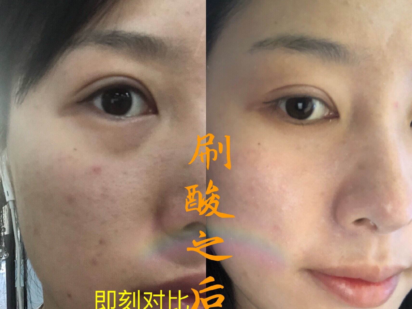 刷酸简直就是面部吸尘器