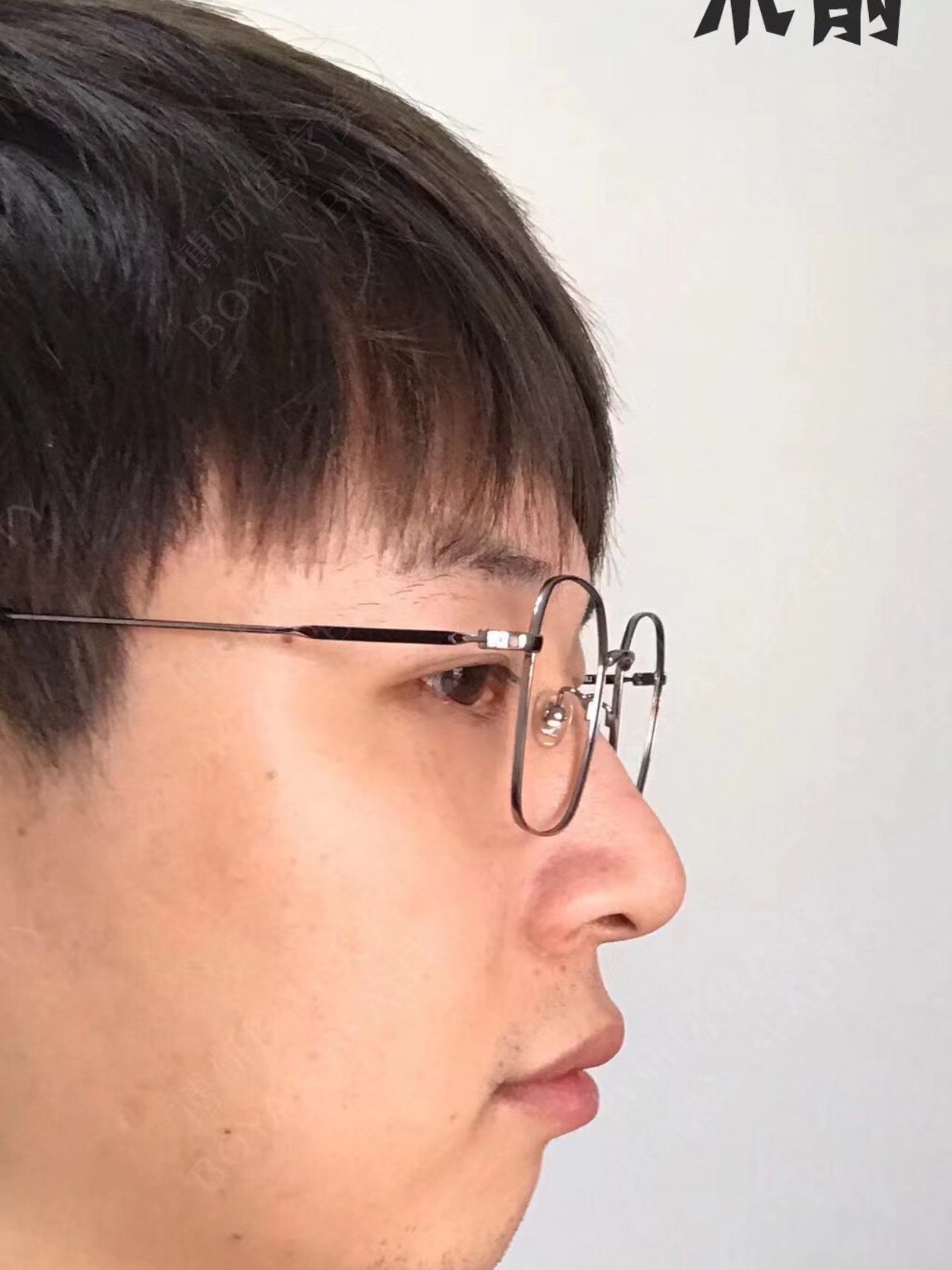 男生鼻子下巴都很重要的,下巴后缩的男生侧面会像憨豆_圈子-新氧美容