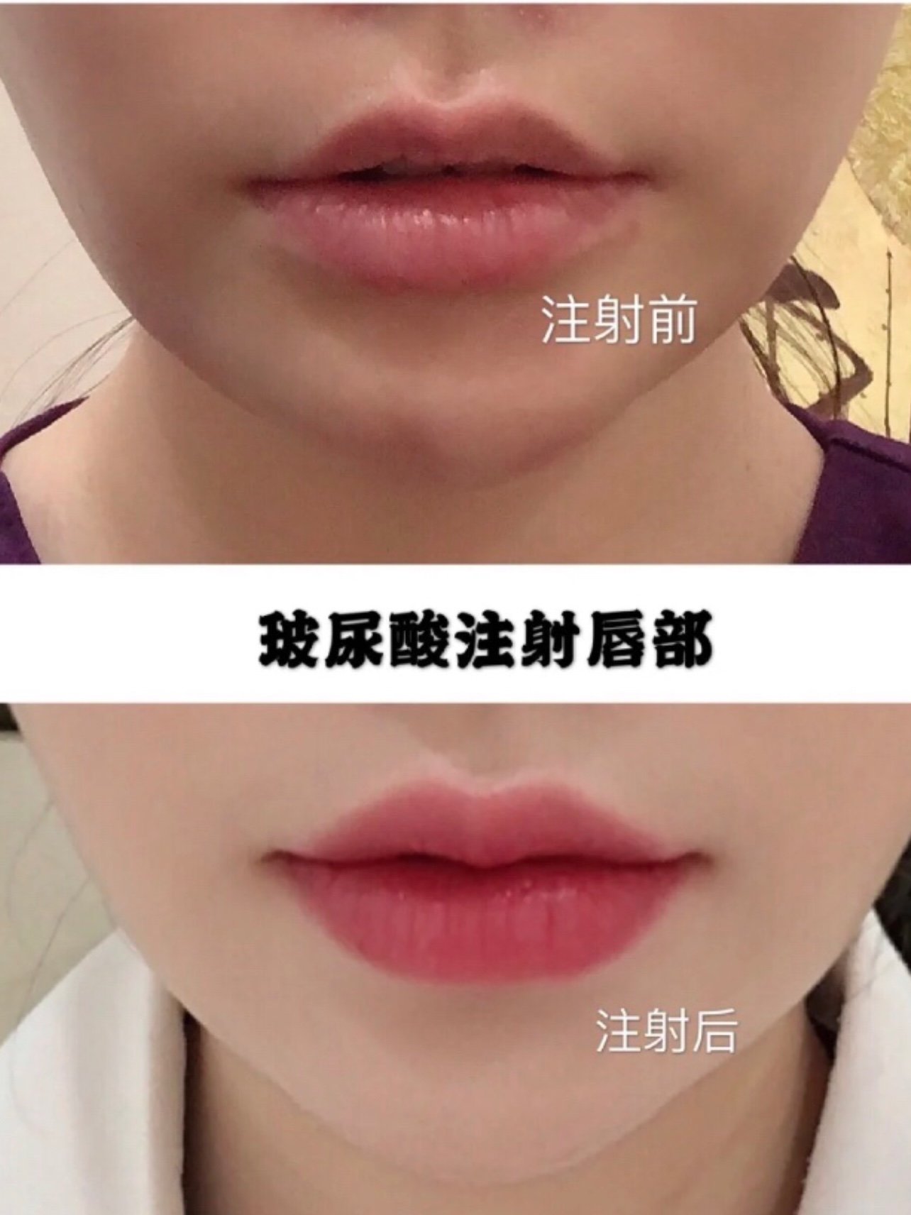 玻尿酸丰唇后多久消肿?