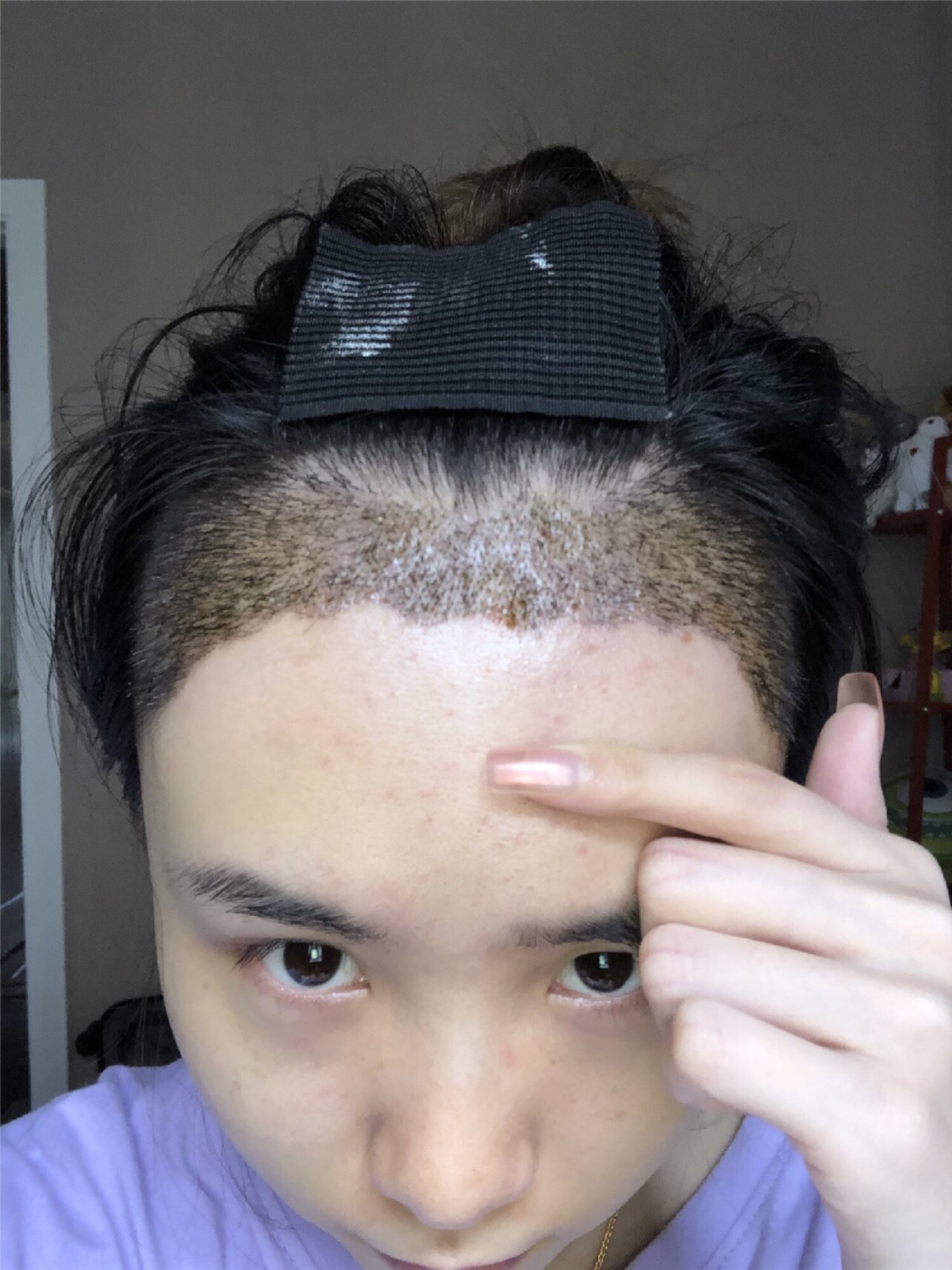植发以后发痒(植发后痒痒怎么回事)