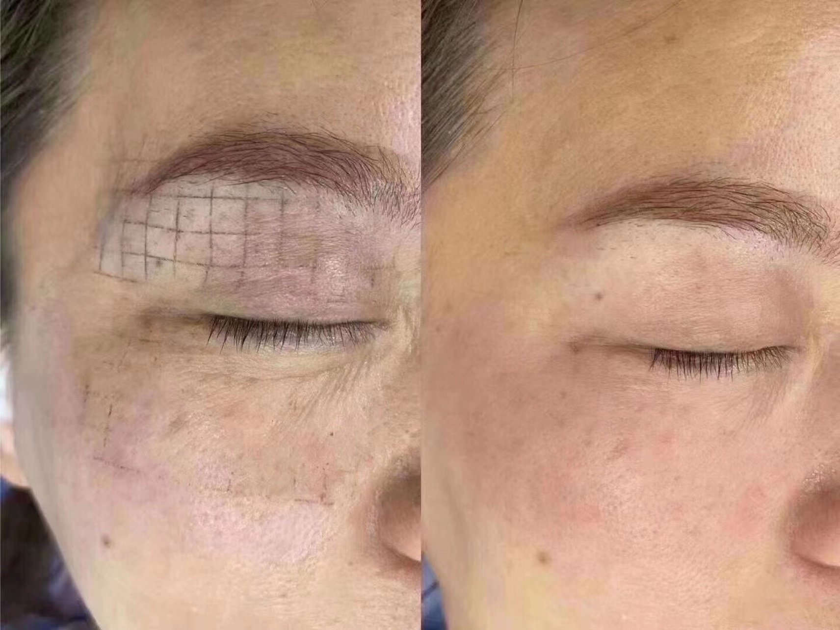 热玛吉眼周是怎样除皱的,你知道吗