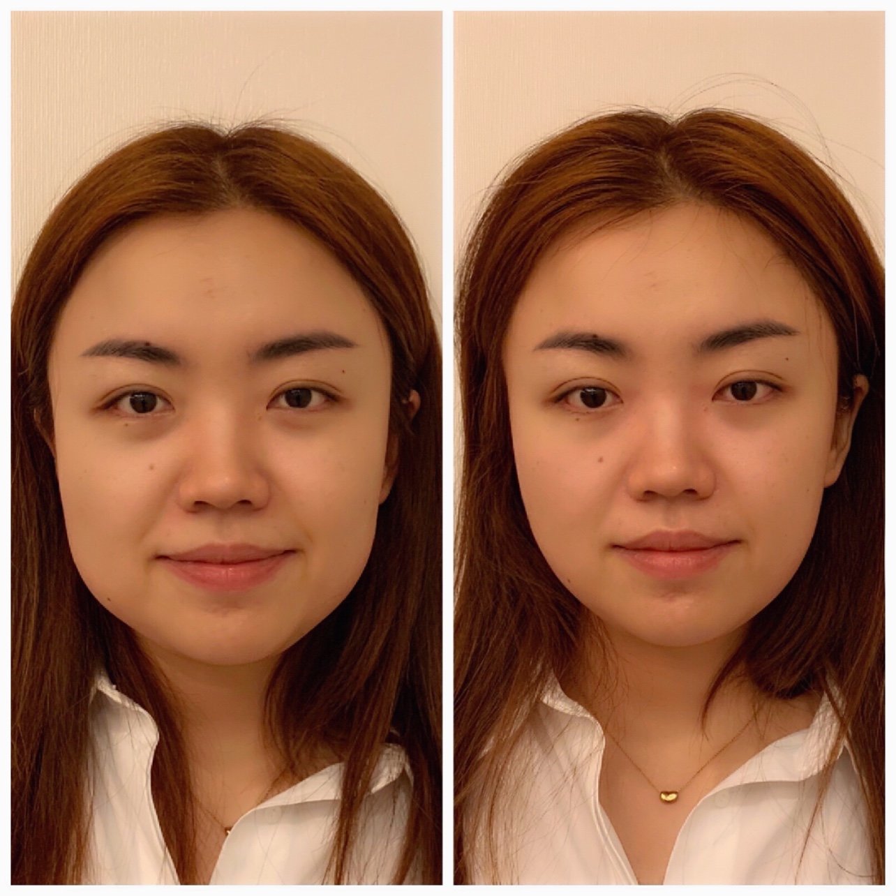 小颜正骨效果情况:照片效果比较明显,肉眼其实没这么