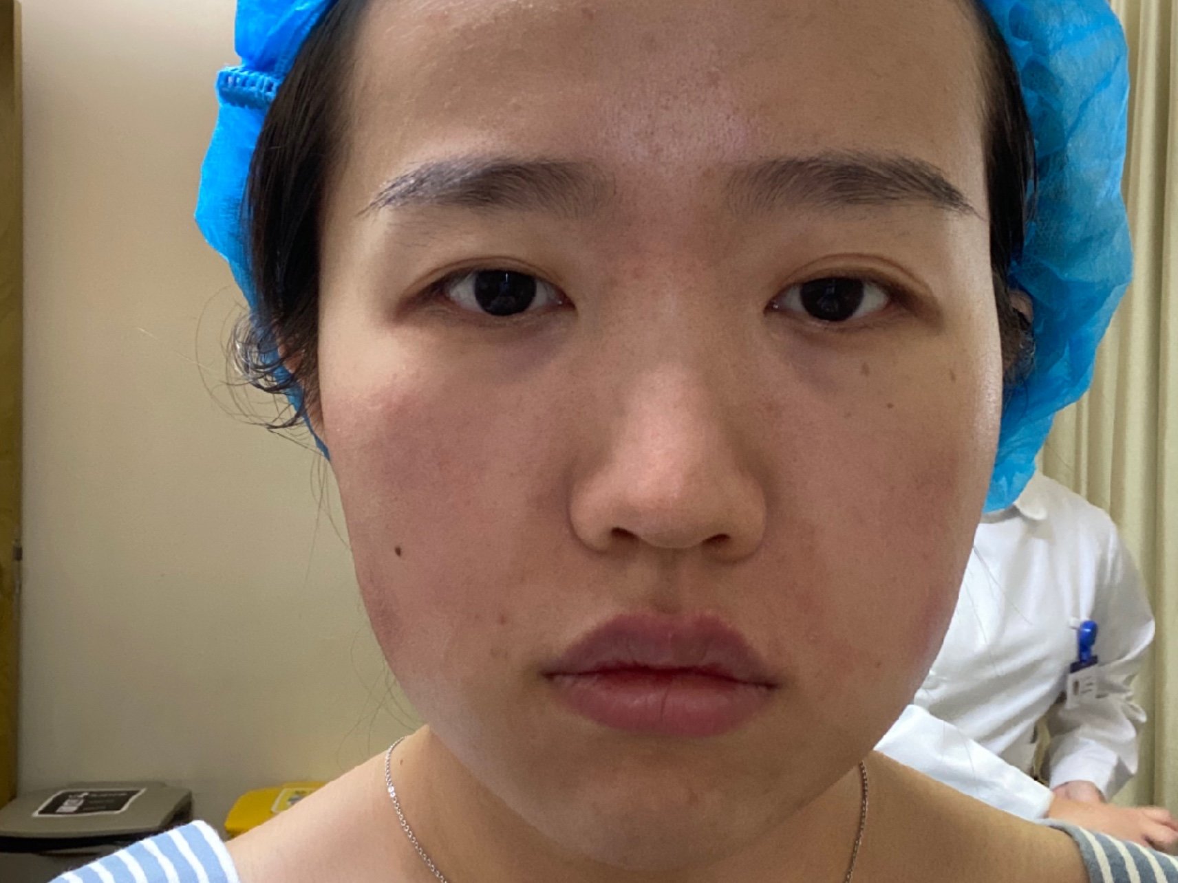 菲洛嘉艺术填充玻尿酸注射面中部让我天生垮脸嘭的一