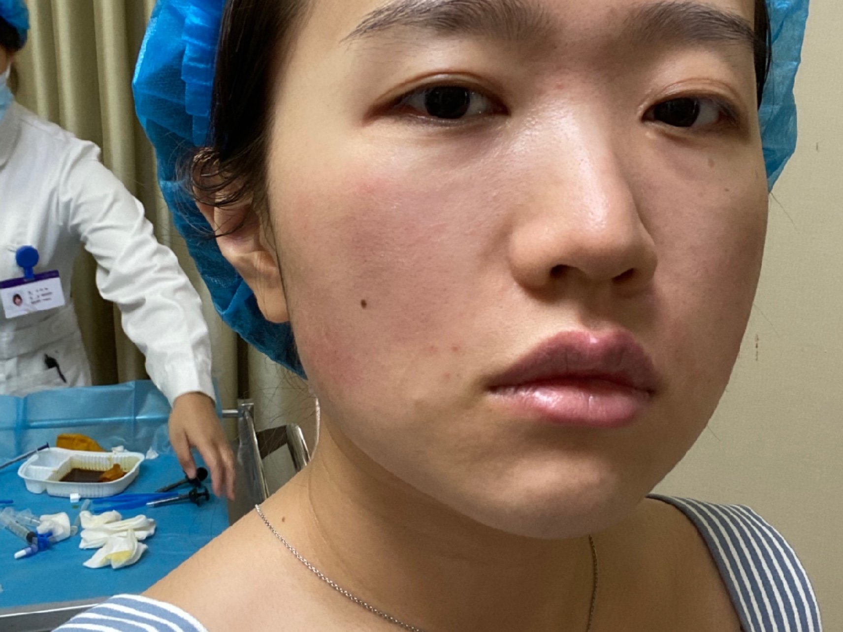 菲洛嘉艺术填充玻尿酸注射面中部让我天生垮脸嘭的一下当然是夸张手法