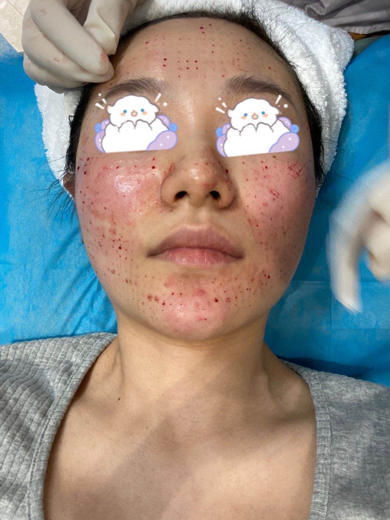 效果情况:补水选择了这个基础水光