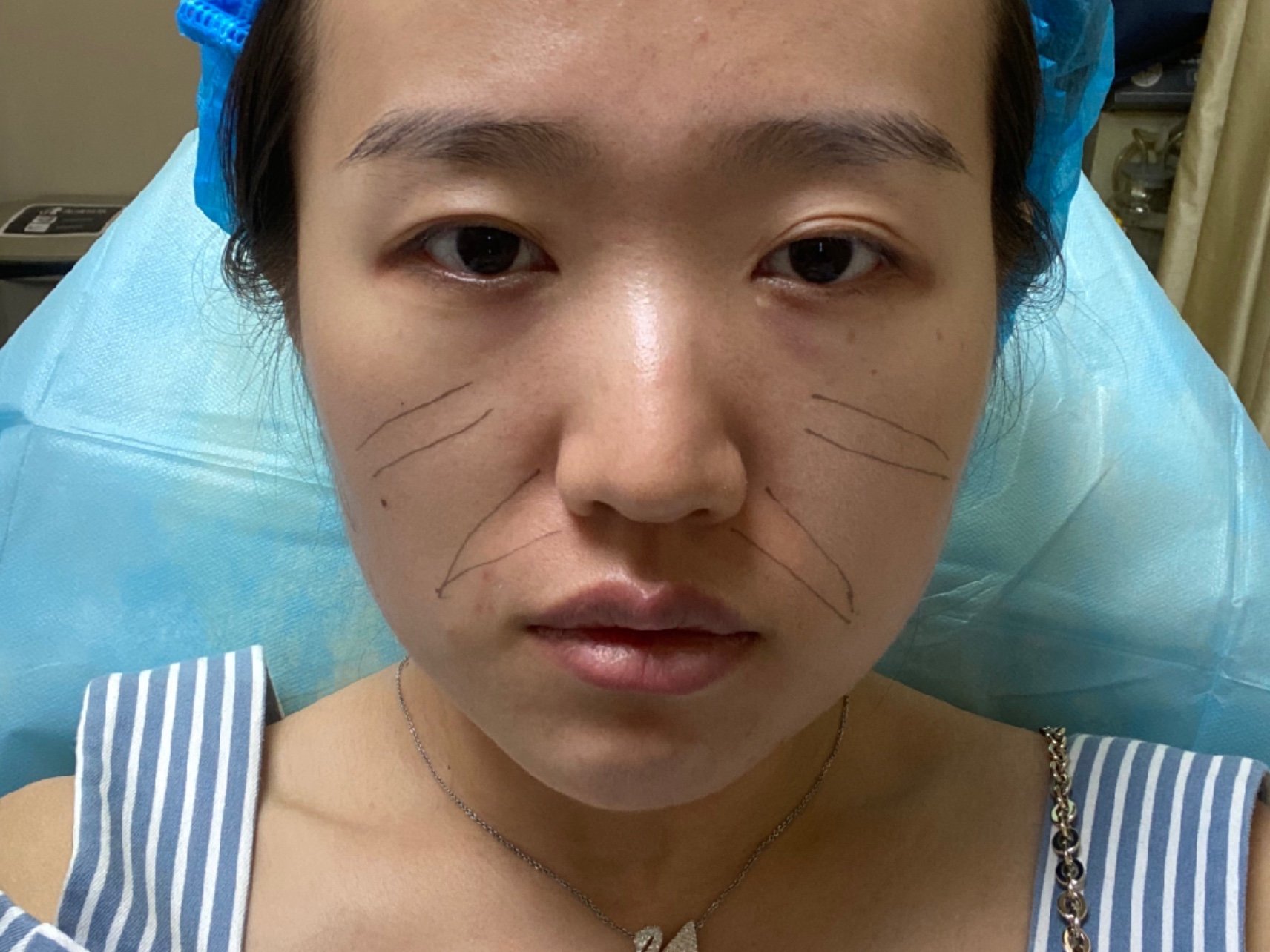 菲洛嘉艺术填充玻尿酸注射面中部让我天生垮脸嘭的一下当然是夸张手法