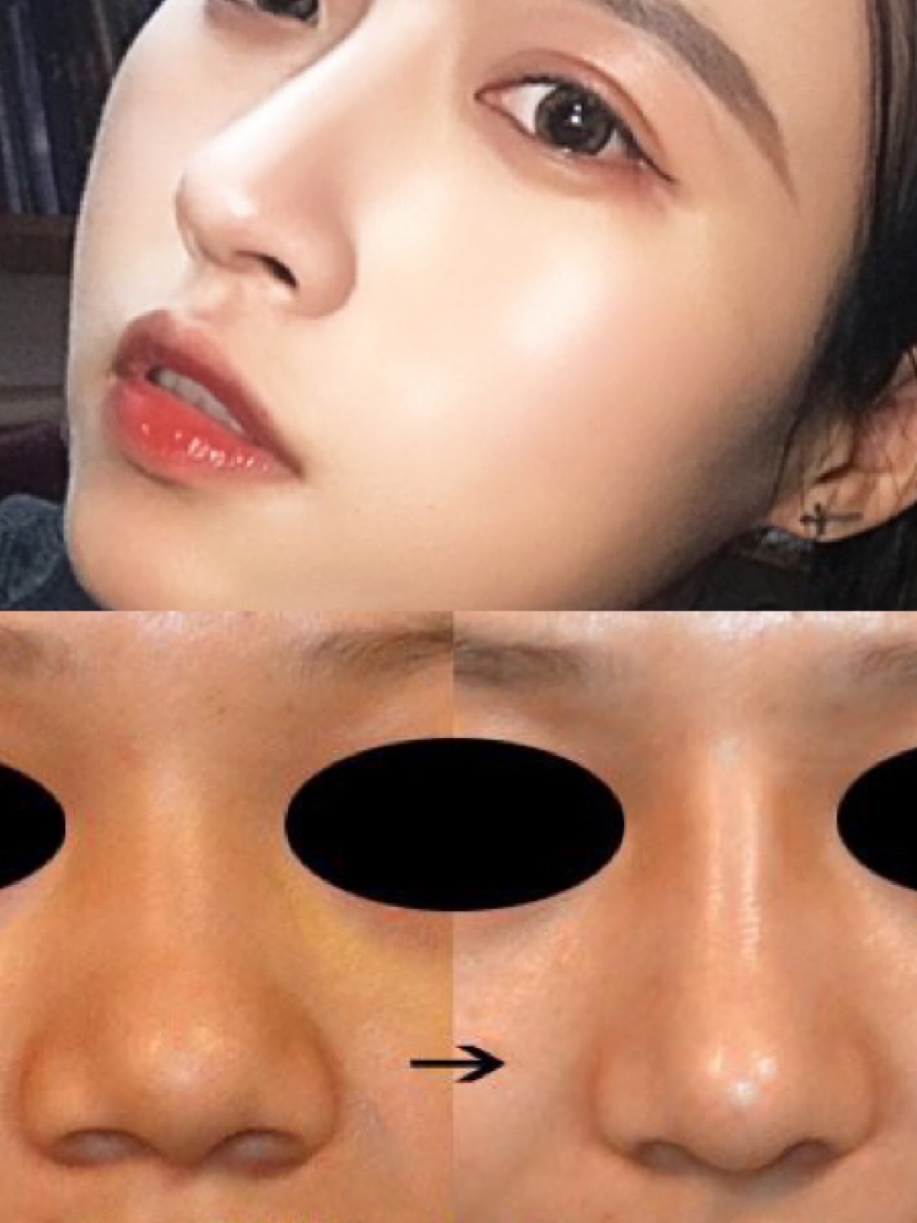 99有没有很多宝宝是这样的:鼻梁高度有,单看侧面鼻子_圈子-新氧美容