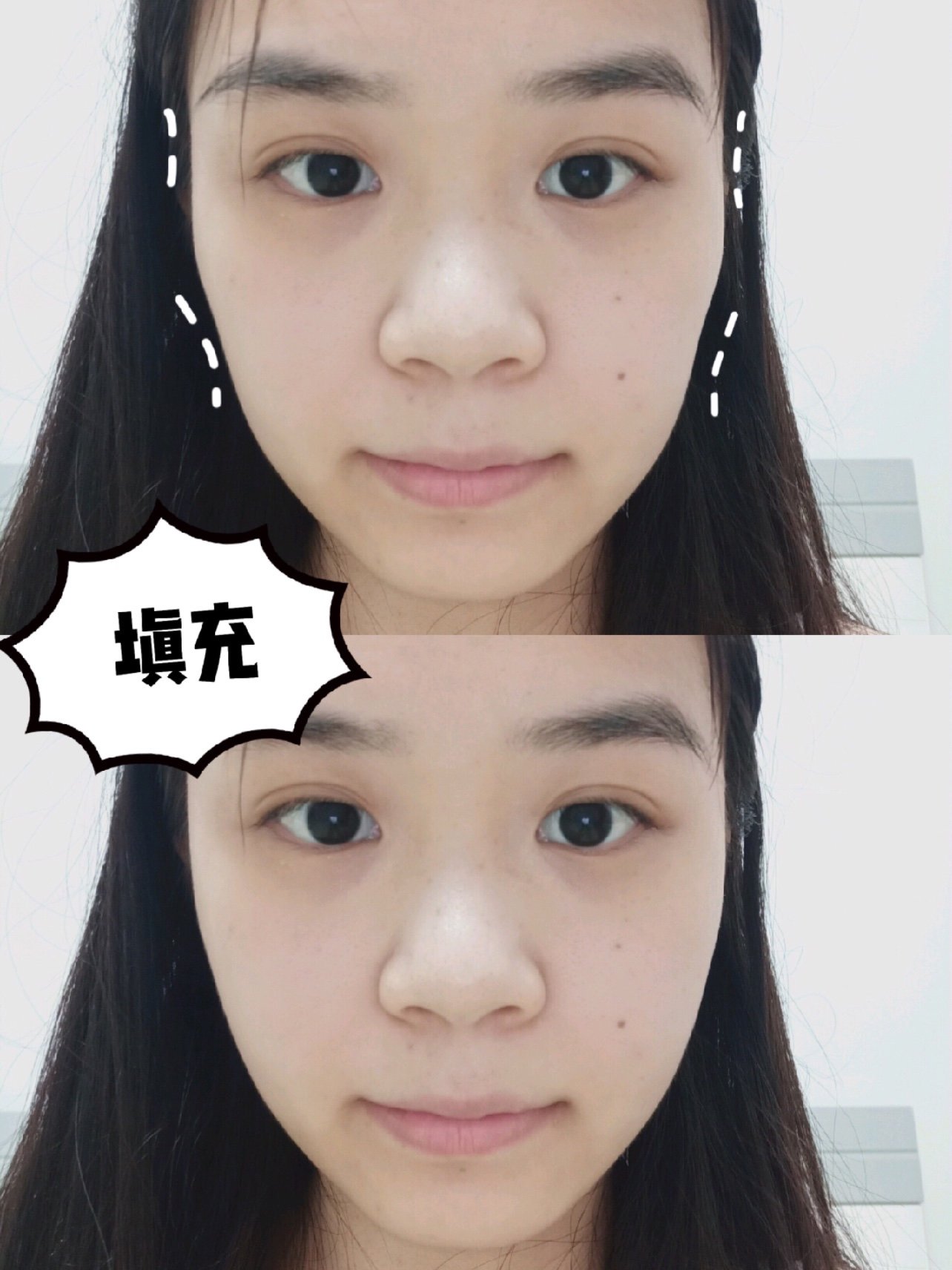 鼻子缺陷是很明显的,可以说是又大又塌,做个