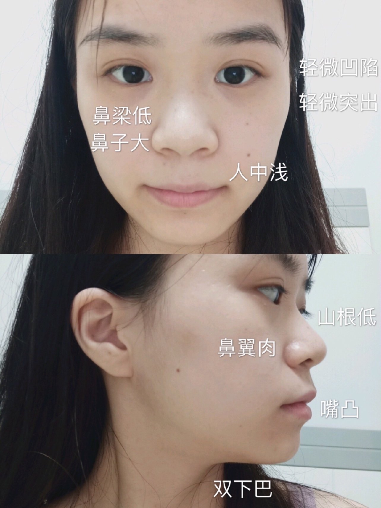 鼻子缺陷是很明显的,可以说是又大又塌,做个