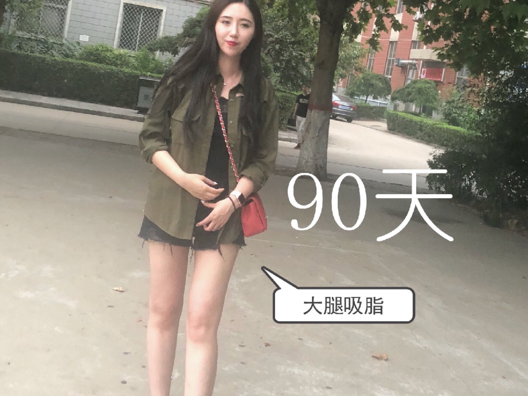 大腿吸脂90天前后变化
