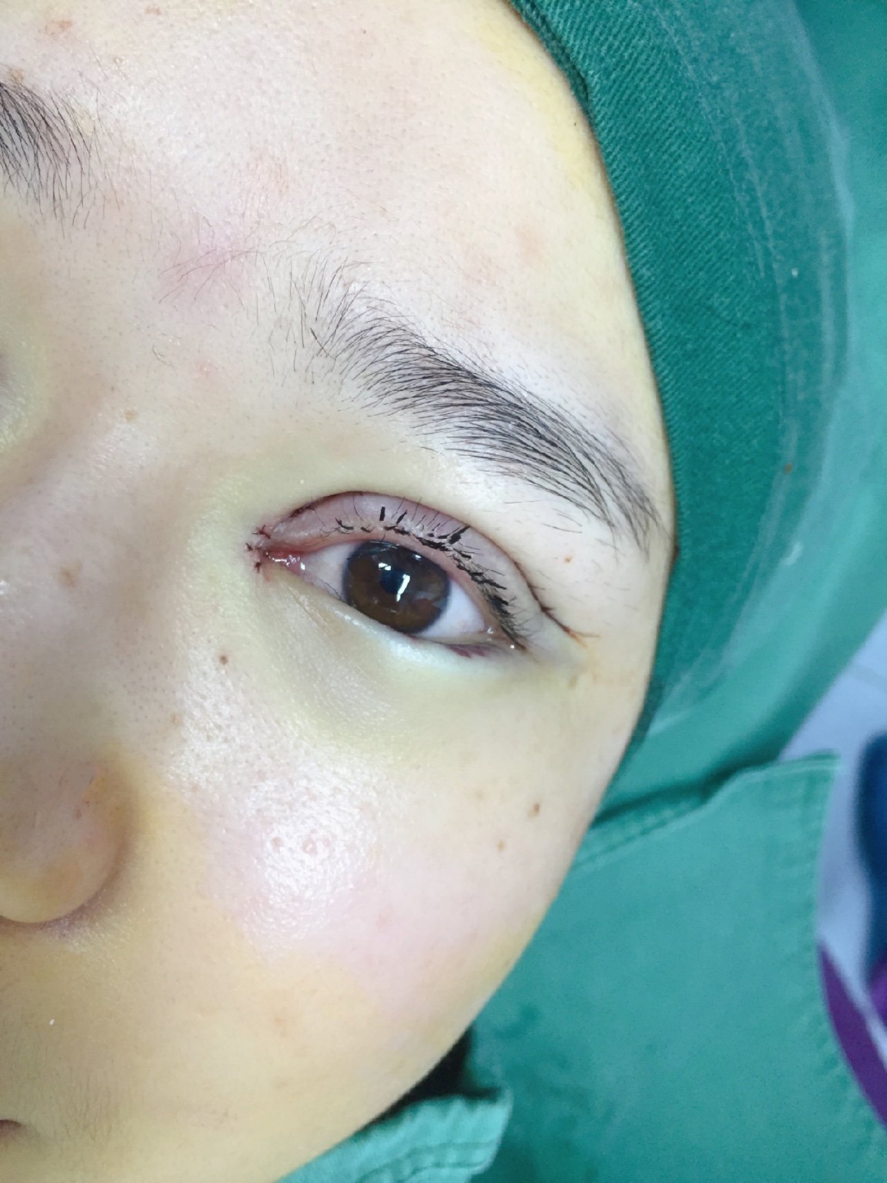 全切双眼皮祛皮祛脂开眼角术后第一天60