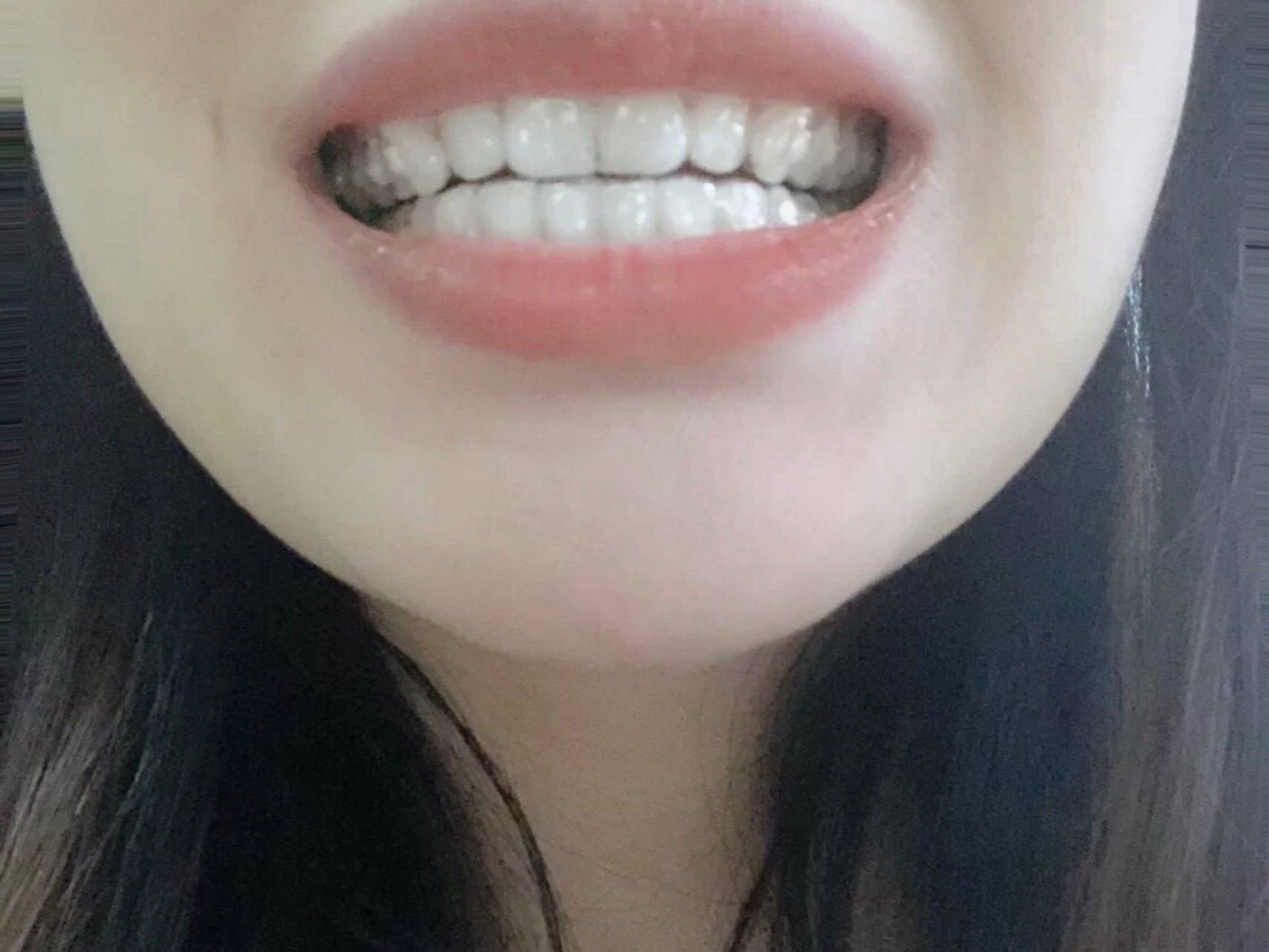 隐形牙套希望快点美呀