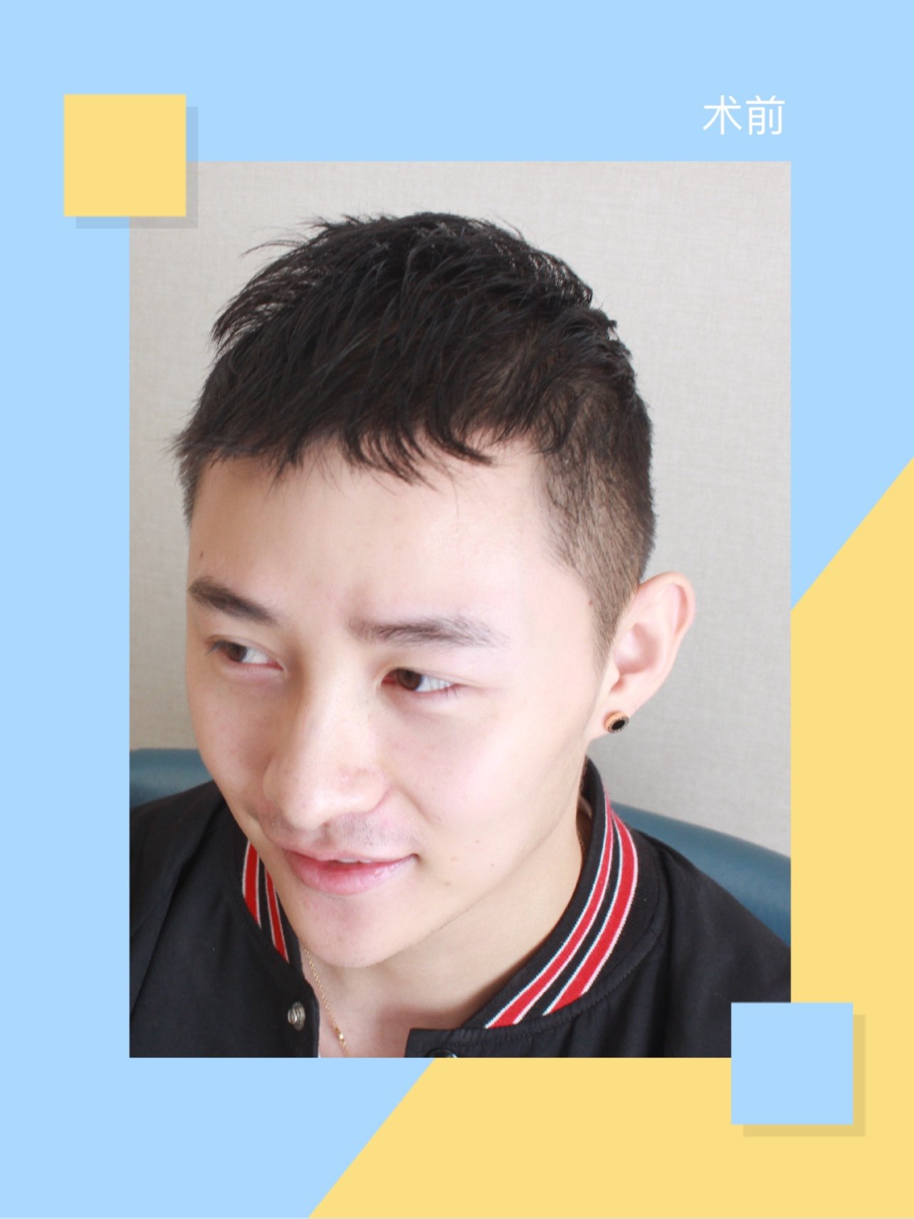 9898发际线 鬓角种植,效果来啦~我一直想有比较硬朗_圈子-新氧