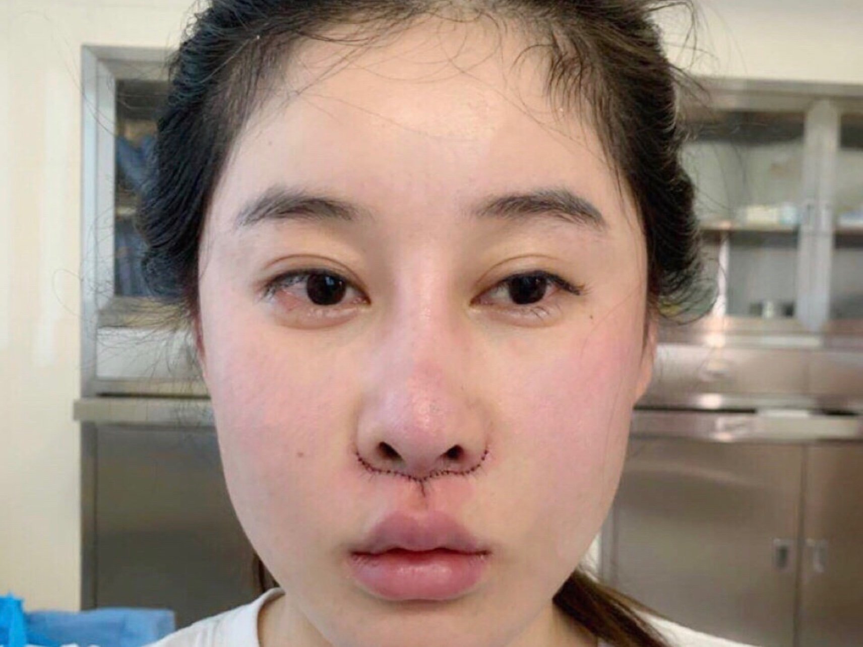 犹犹豫豫了两三年昨天终于把人中缩短给做了!