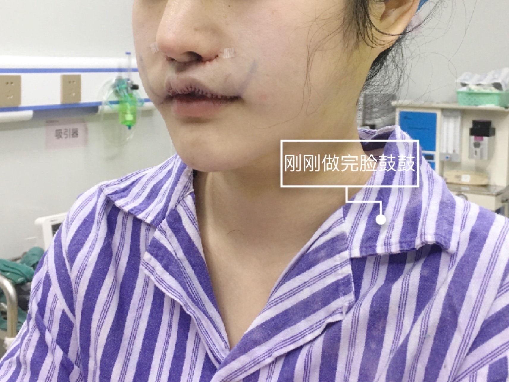 做了m唇口内切口的嘴角上扬和人中缩短