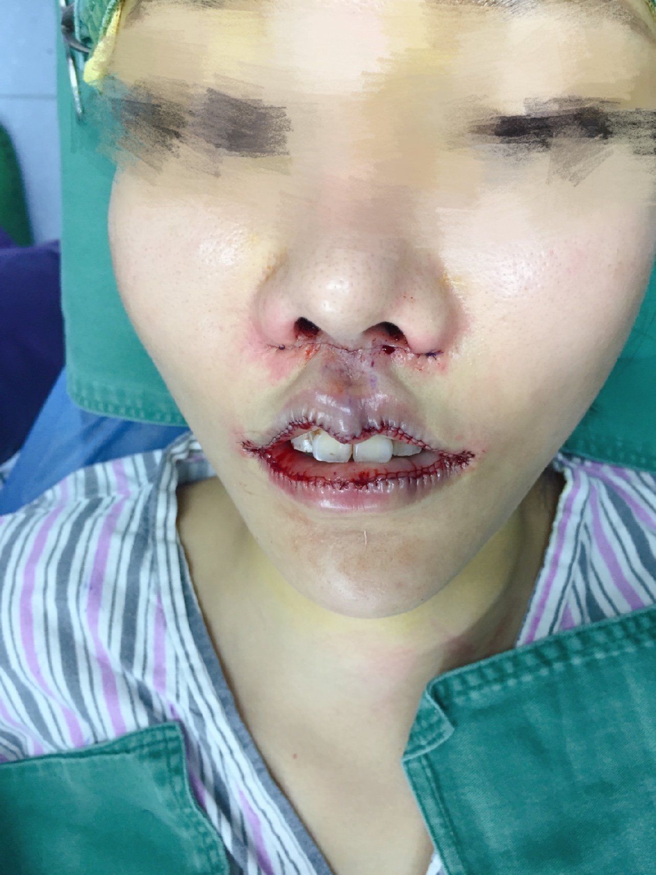 唇部综合 人中内外缩短手术第一天