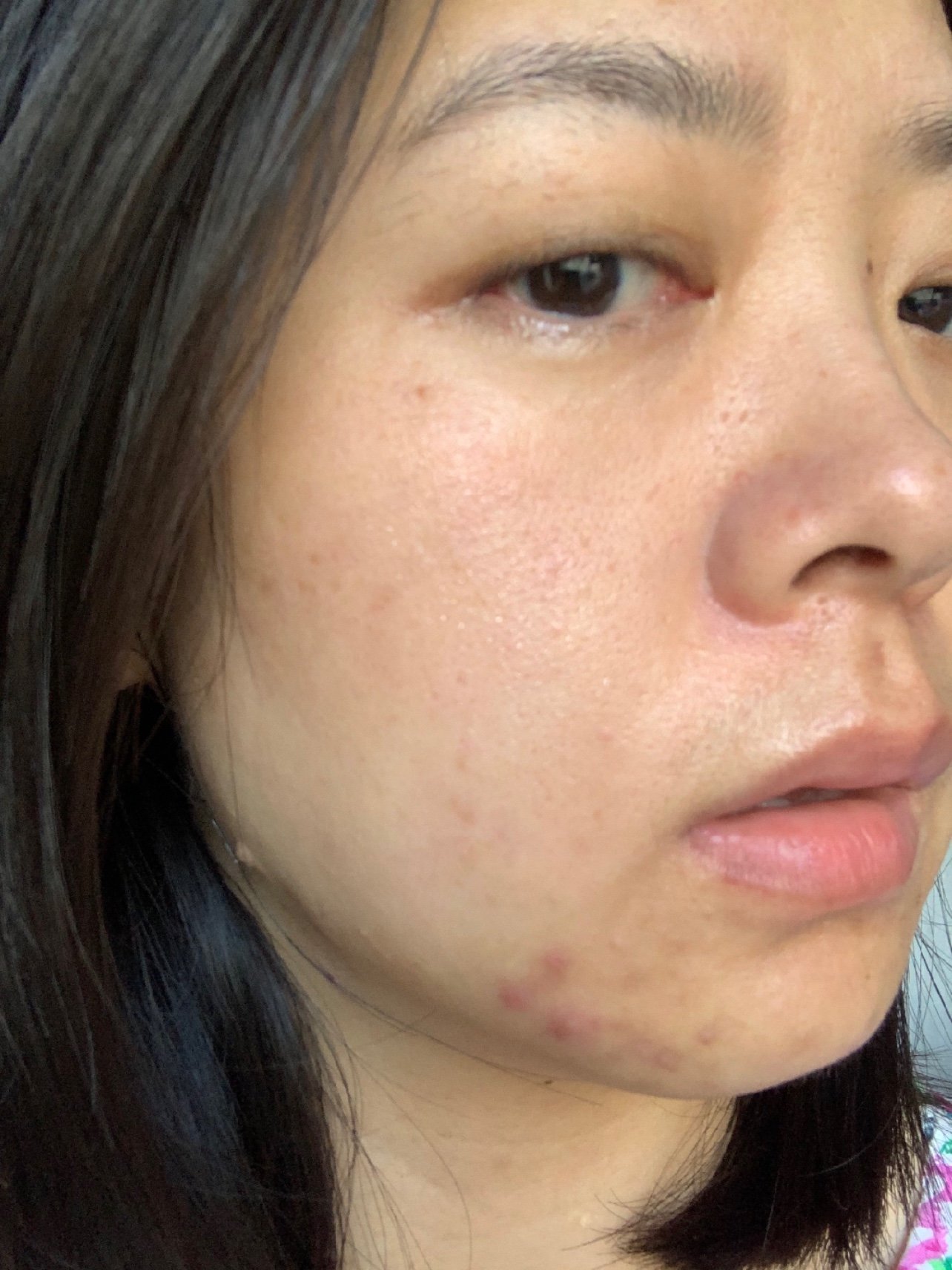 刷酸一周后的样子,之前说刷酸后会大面积爆痘,让我有_圈子-新氧美容