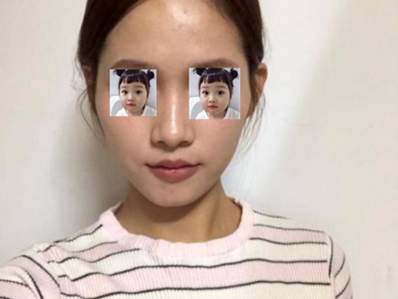 女孩子真的是只要脸上有一点凹陷,就特别显老,看起没_圈子-新氧美容