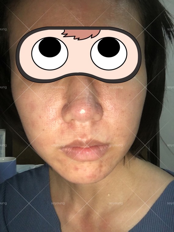 黄金微针第三天,结了很多针眼状的痂以及有一些闭口冒_圈子-新氧美容