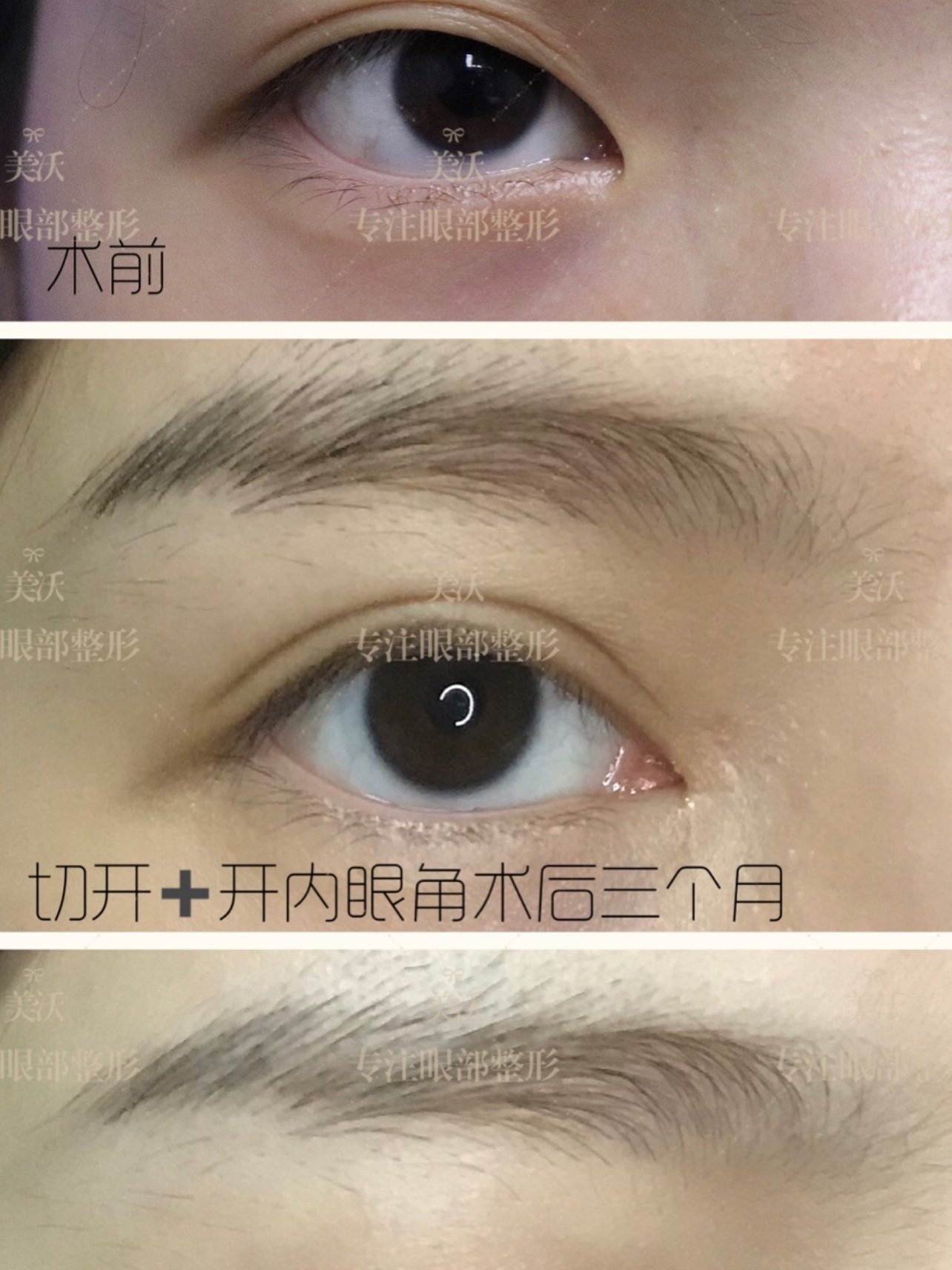 轻微眼凸可以做双眼皮手术吗?