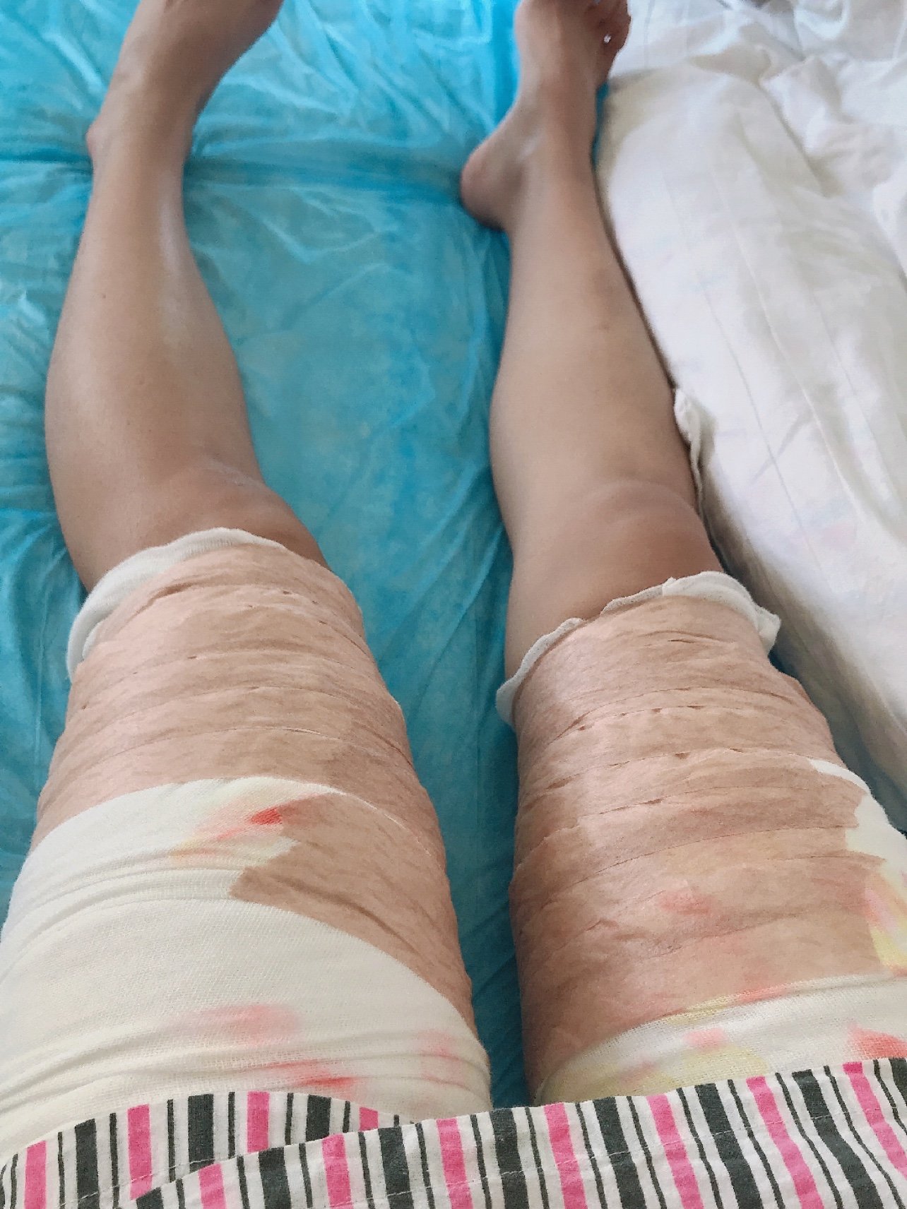 抽的是大腿的脂肪,我自己本来也不是很胖,身高170_圈子-新氧美容整形