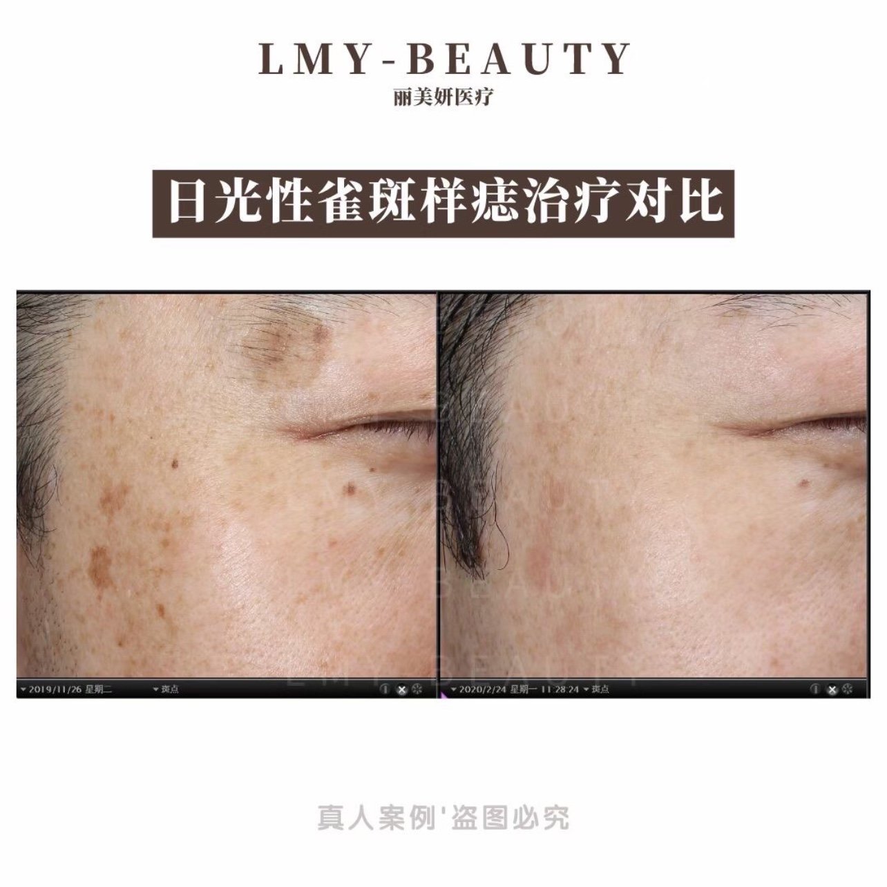 picosure蜂巢皮秒