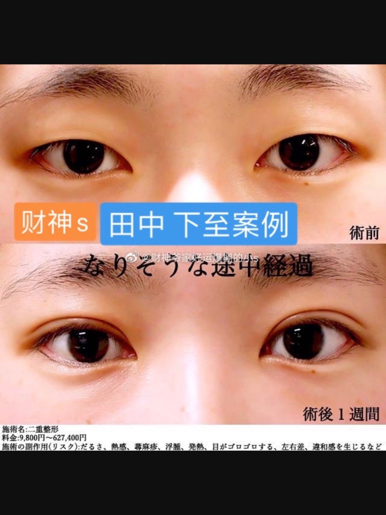 首页 此页面仅支持预览 Avatar 吉大金 533篇日记 拉踩中国医生 日本做的眼睑下至有多自然 从夸张的 后sline 到常见的下至做法 适合自身眼型是关键 大金昨天还分享国内不正规医院下至做成恐怖片的危害 今天就被日本这家医院种草了 你们点击下方标签