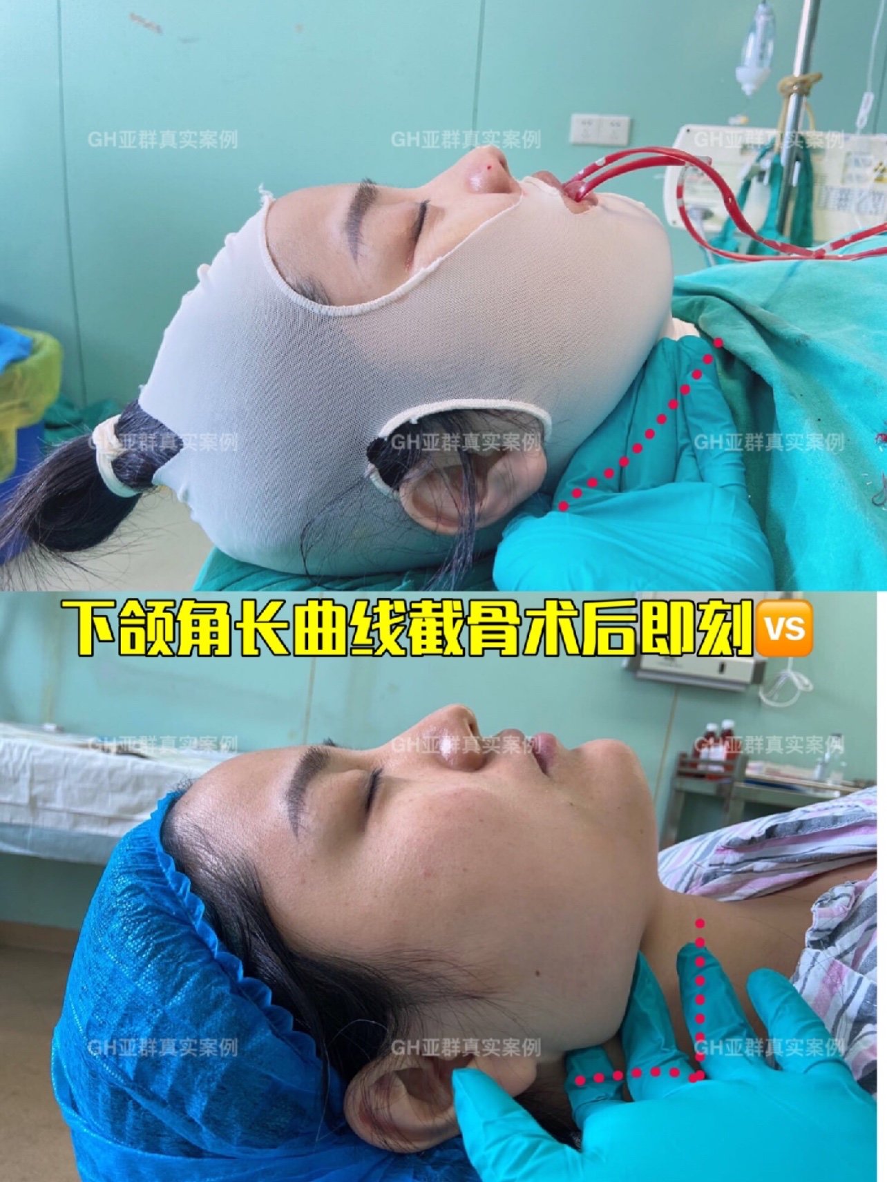 下颌角长曲线截骨术后即刻