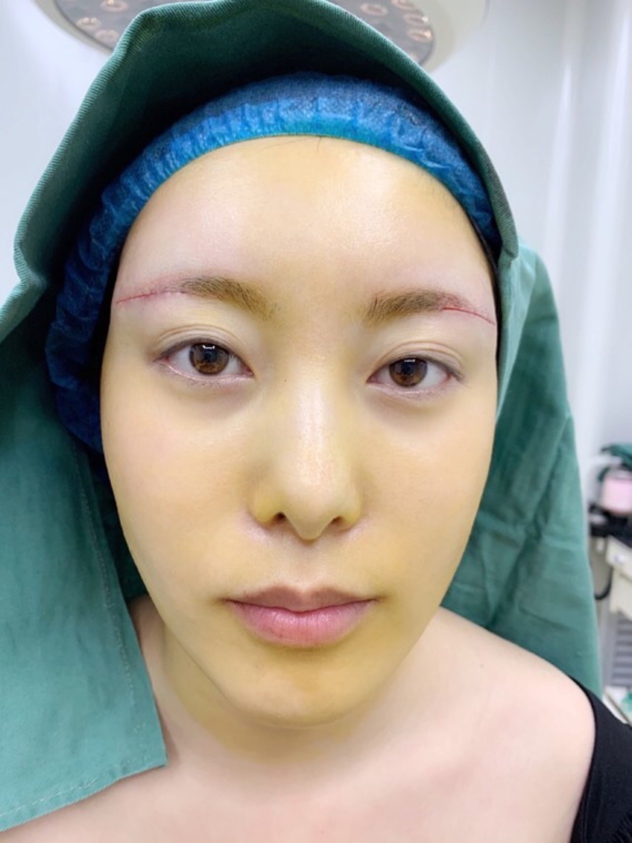 我的提眉手术结束了,自己状态比我想象的要好,做完也_圈子-新氧美容