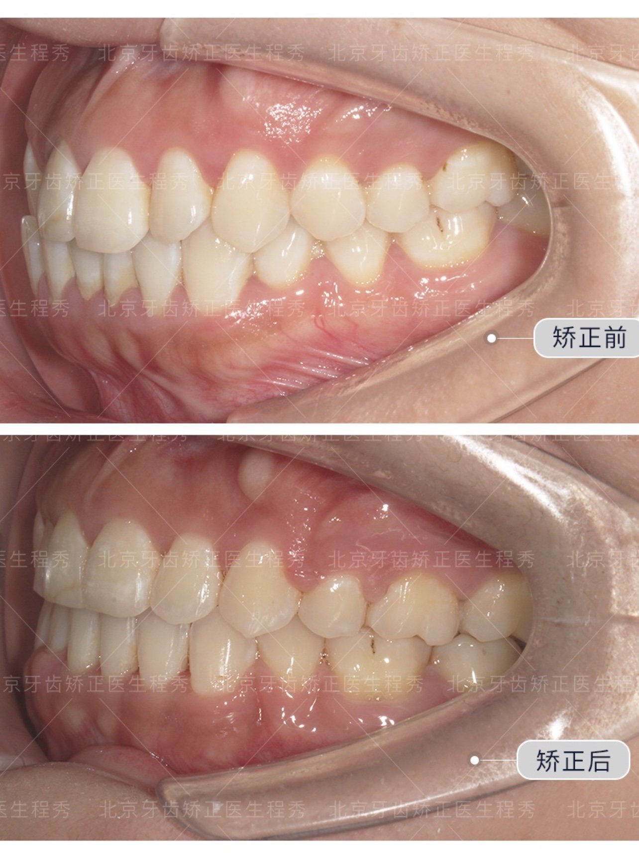 患者因为牙齿微突做矫正,拥挤前突集中在牙弓前部,经