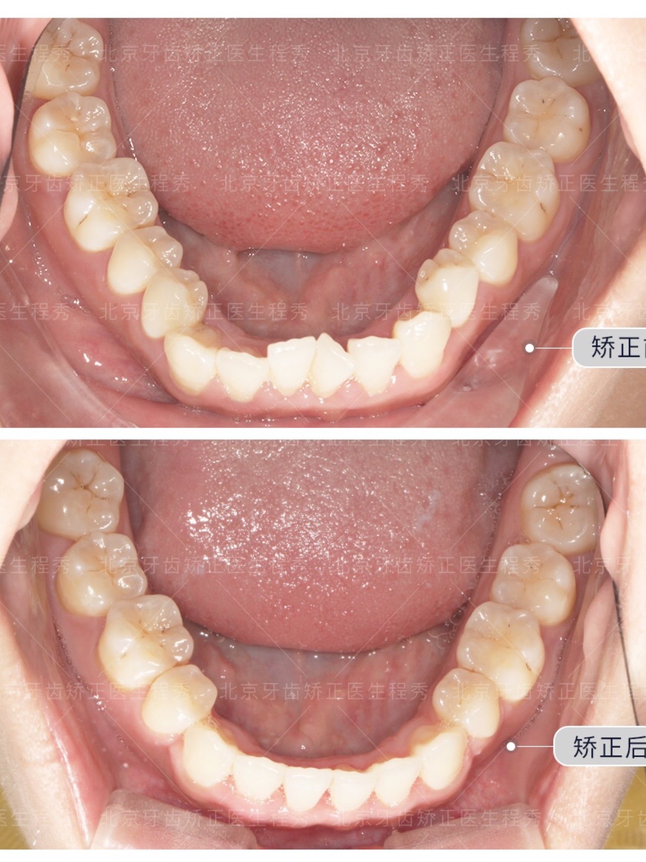 患者因为牙齿微突做矫正,拥挤前突集中在牙弓前部,经_圈子-新氧美容