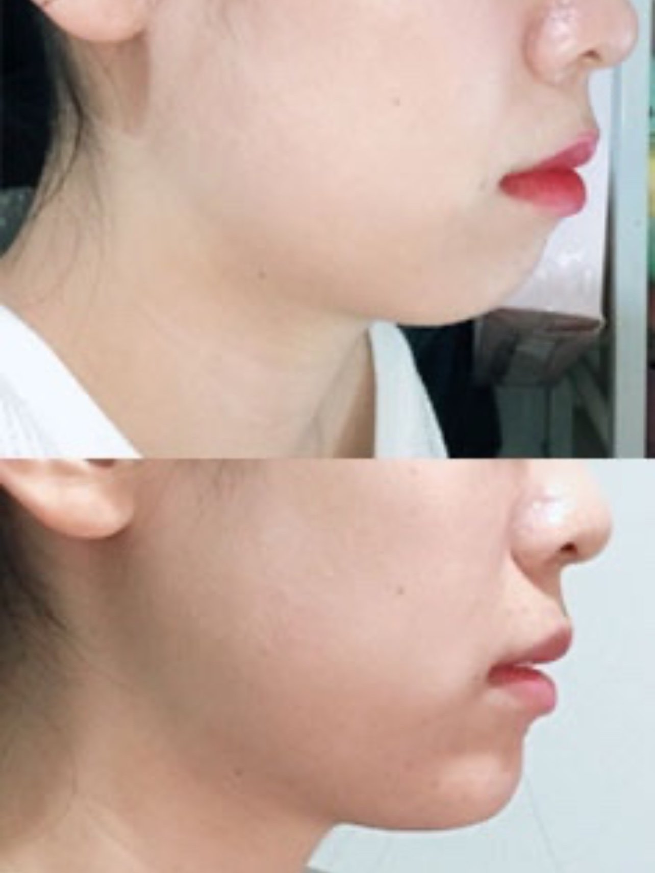 7815常见的5种凸嘴原因:11566牙性凸嘴龅牙,深覆合_圈子-新氧