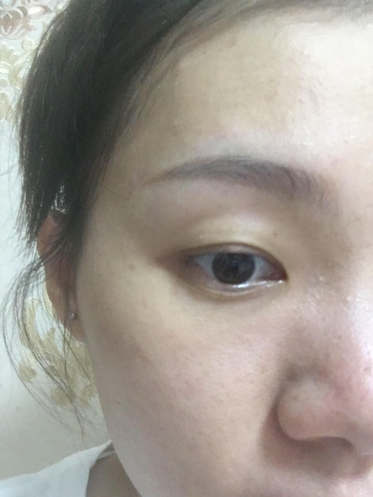 麦粒肿好了留下疤怎么办