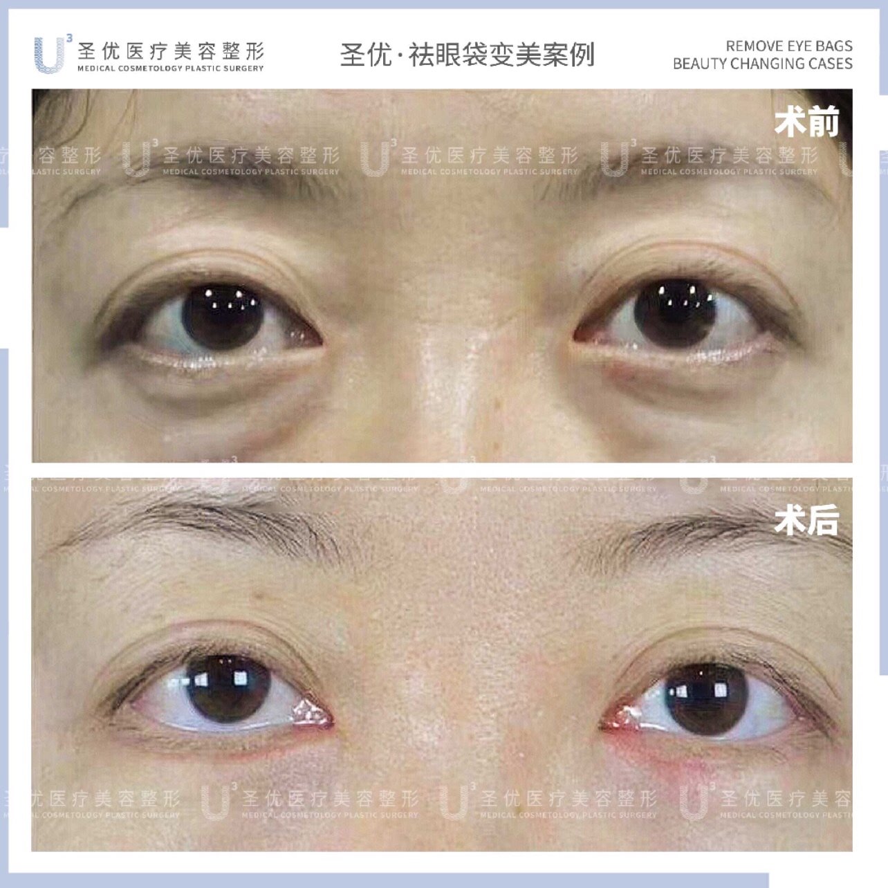 下睑眶膈脂肪膨出下垂泪沟凹陷