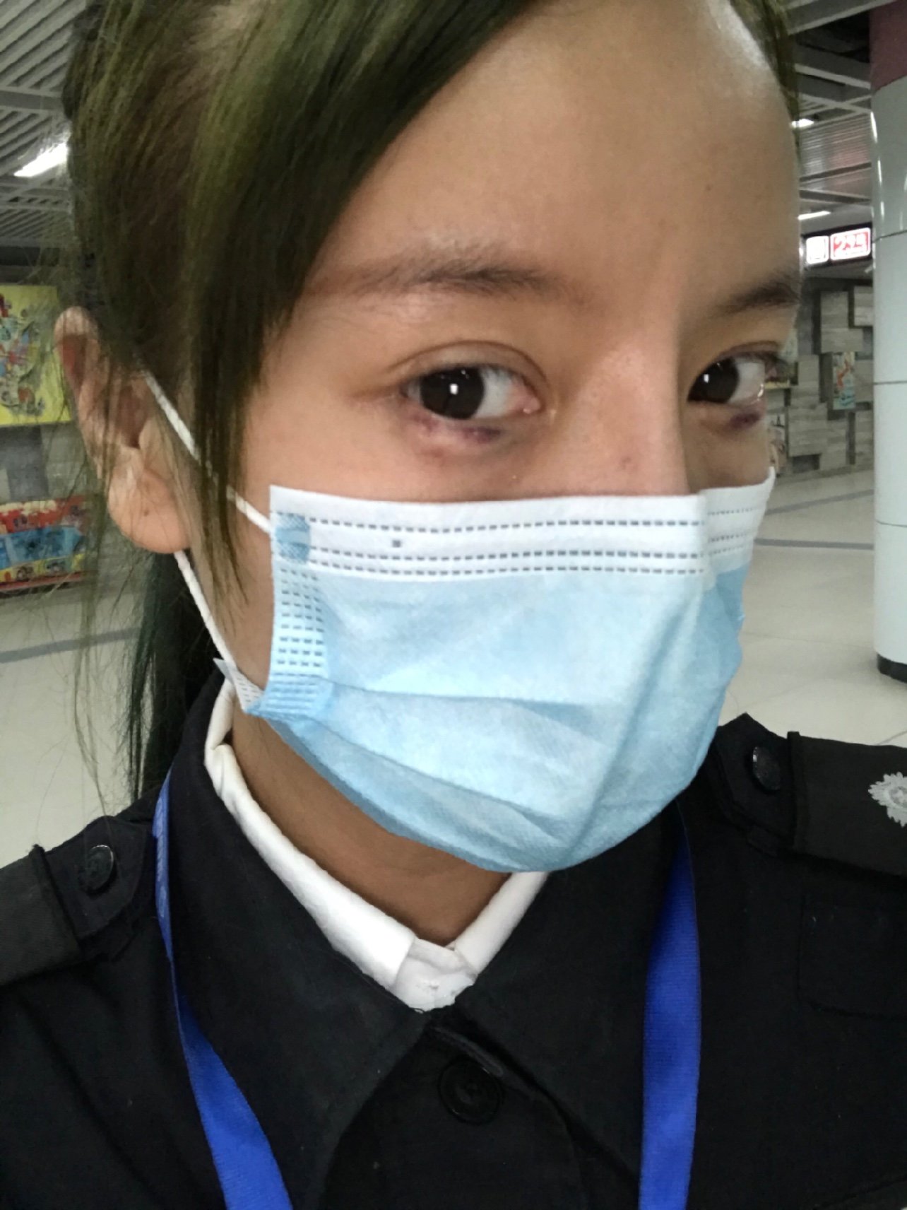 现在丰卧蚕的第2天,眼睛淤青加肿,第一张照片是昨天_圈子-新氧美容