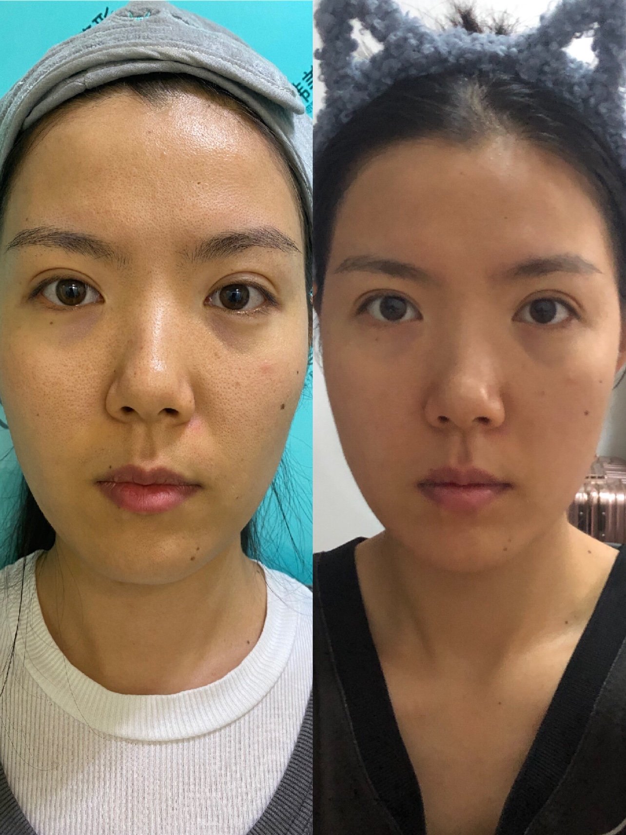 新氧体验官热拉提第7天对比