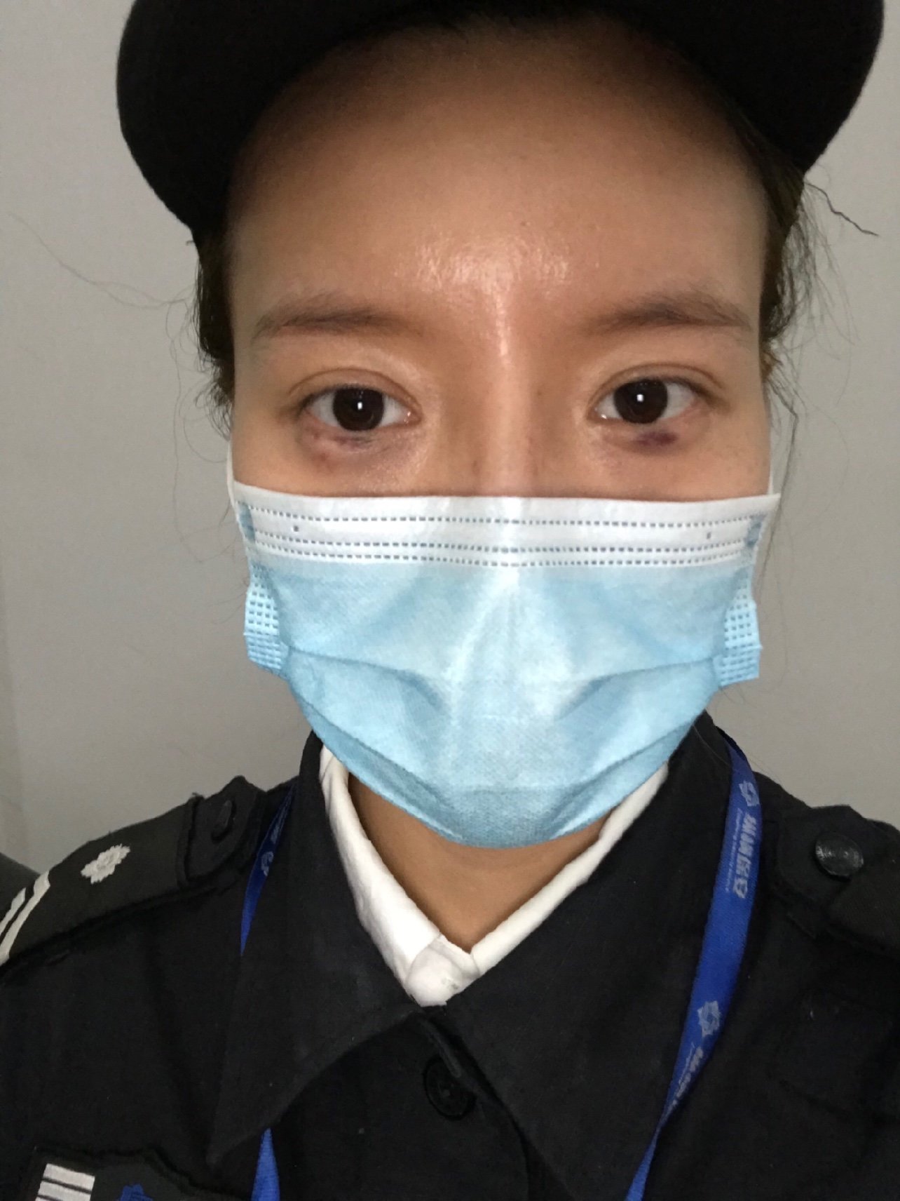现在丰卧蚕的第2天,眼睛淤青加肿,第一张照片是昨天_圈子-新氧美容