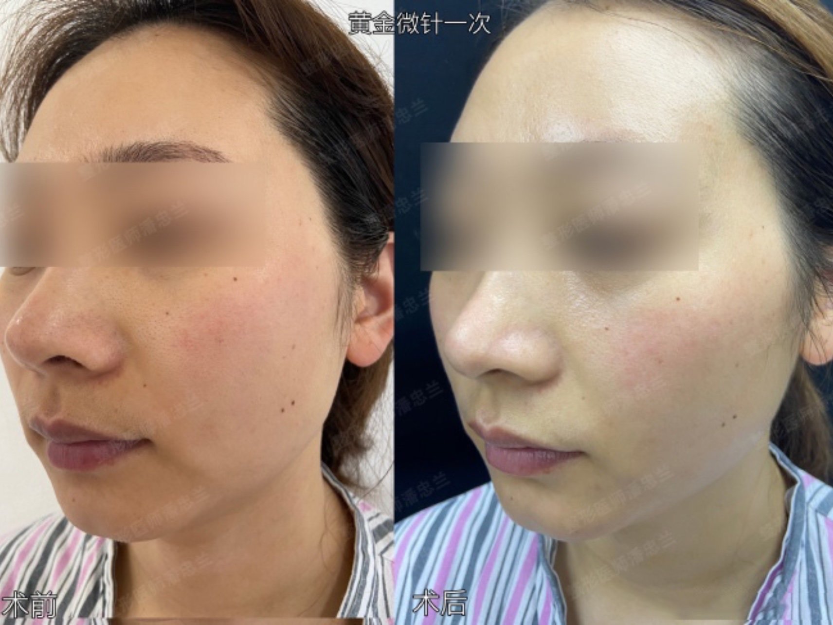 黄金微针治疗毛孔粗大一次治疗效果对比