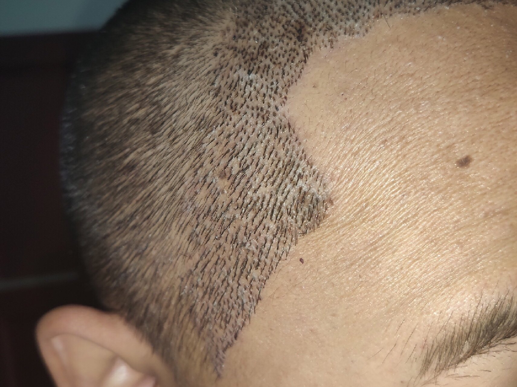 植发第5天,已洗头,清理了部分血痂,还有部分未清洗_圈子-新氧美容整形