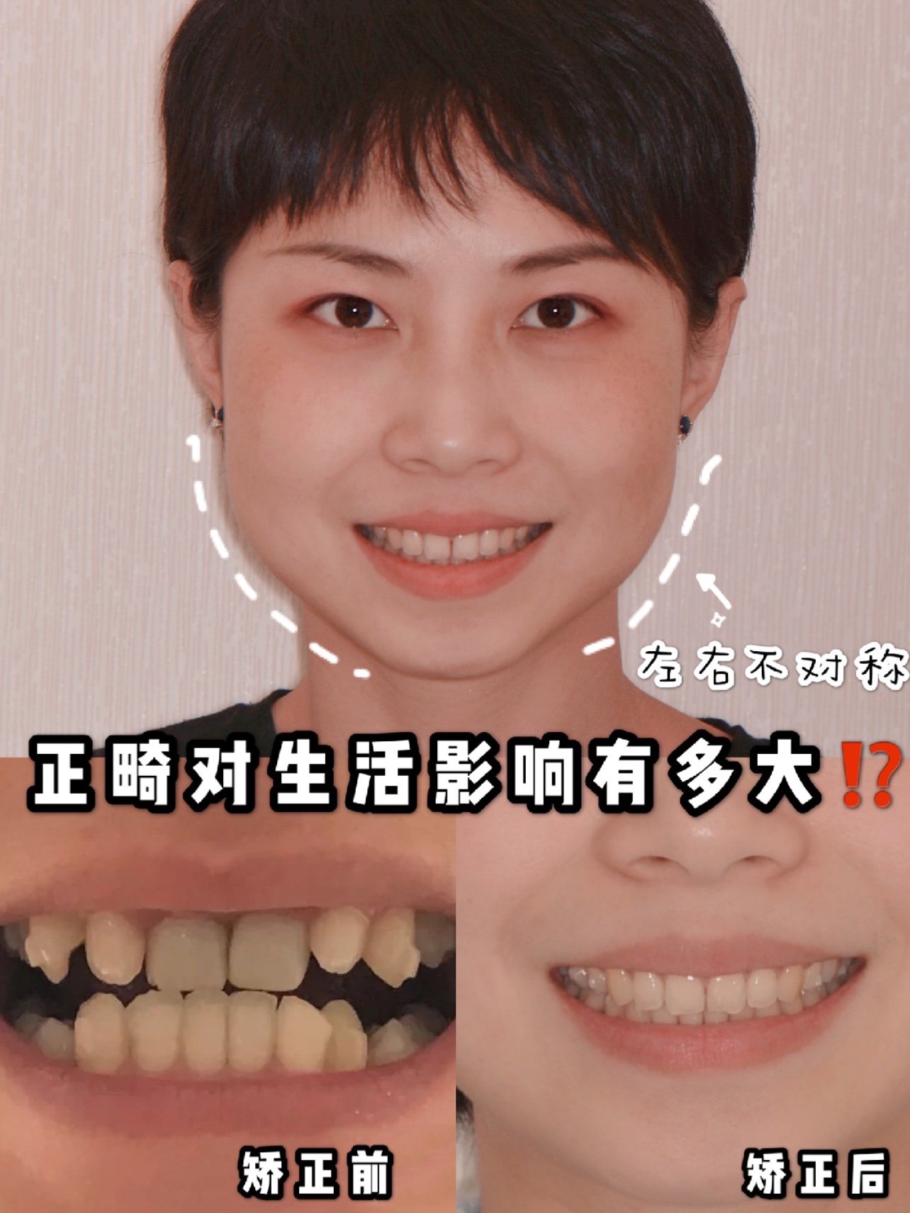 第三节 舌骨下肌群切开术/舌骨悬吊前移术-口腔颌面外科手术-医学