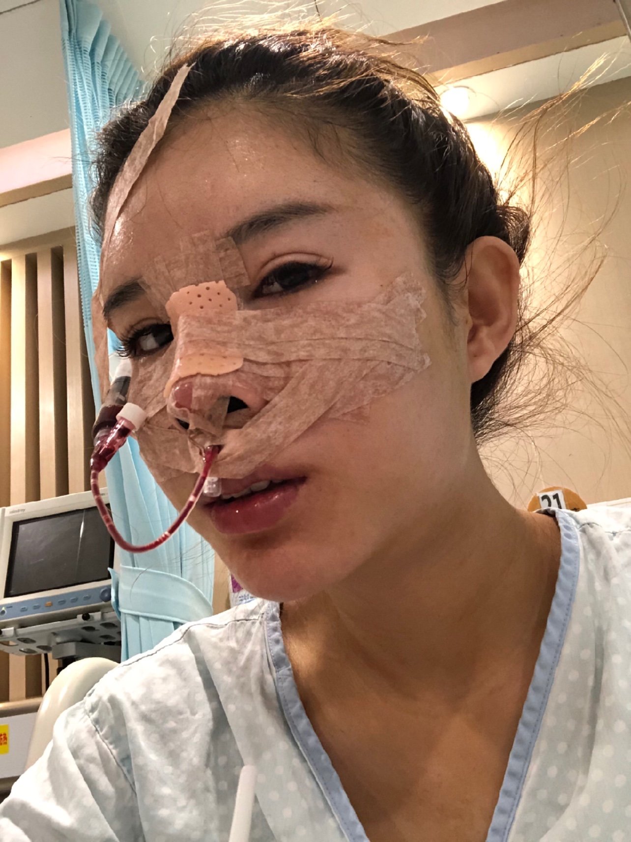 肋软骨隆鼻手术第一天 做手术当天没有紧张也不怕 因_圈子-新氧美容