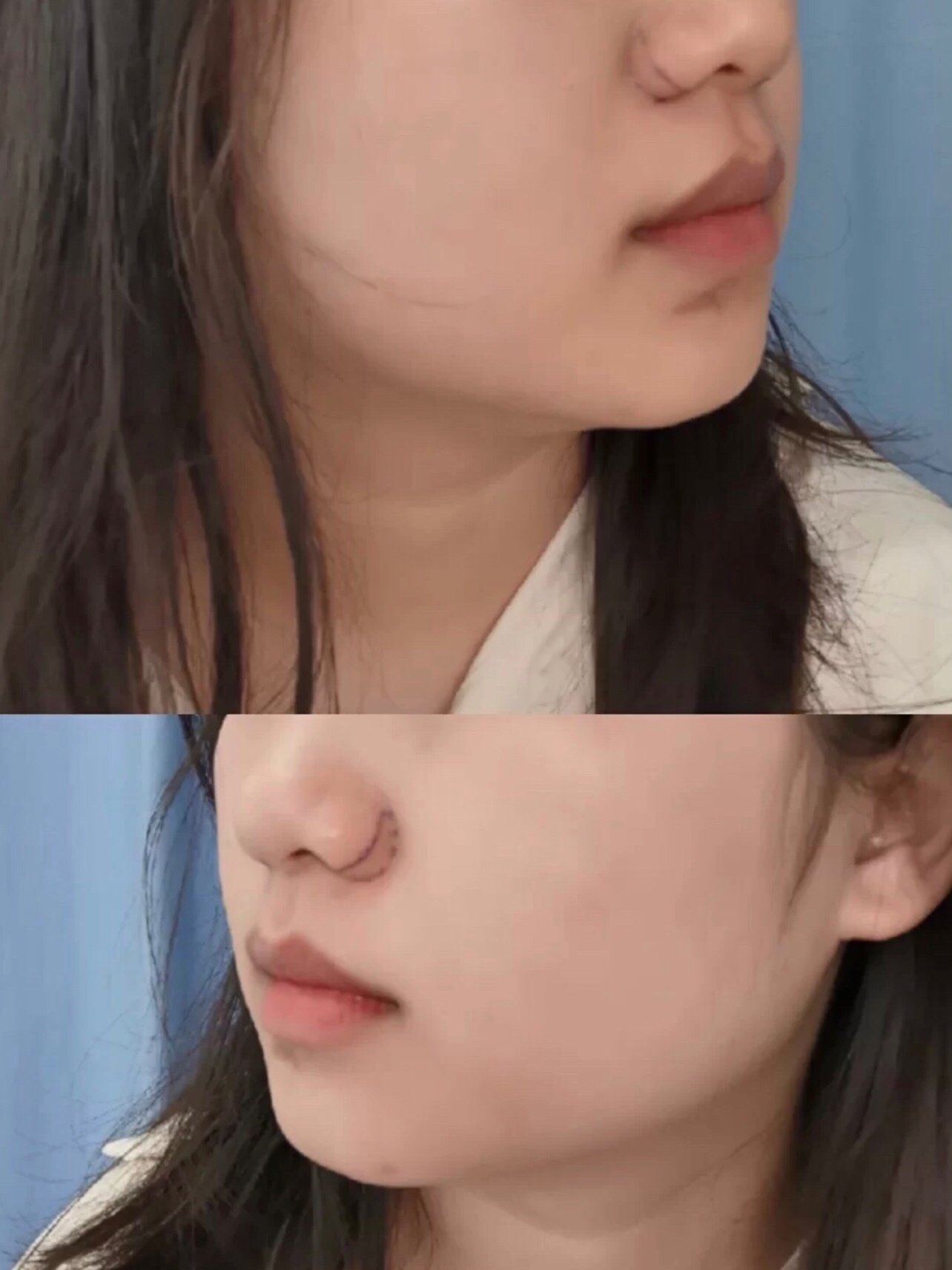 鼻翼宽大,显得比较钝的女生如果想要鼻子变得立体精致_圈子-新氧美容