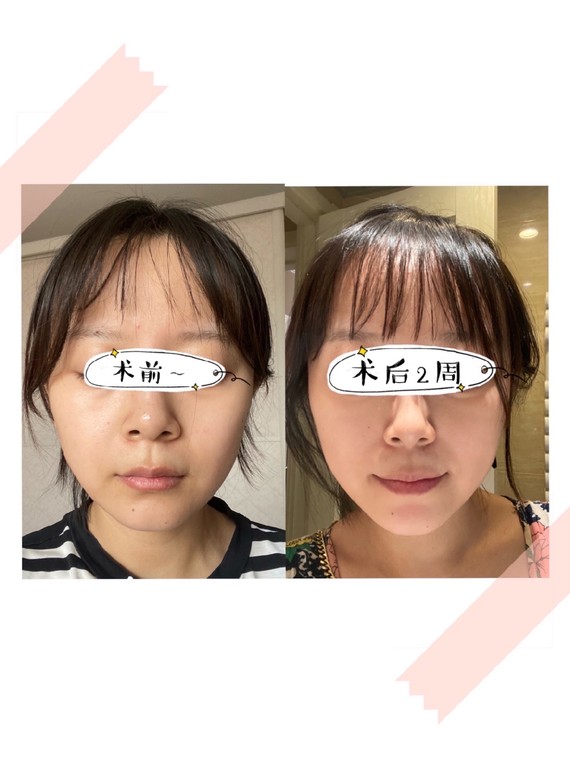 热拉提plus术后两周对比心得