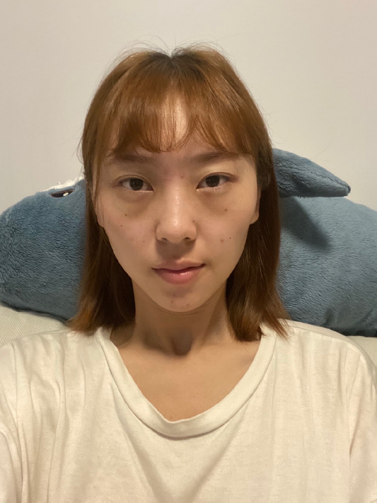 祛眼袋术后第2天.