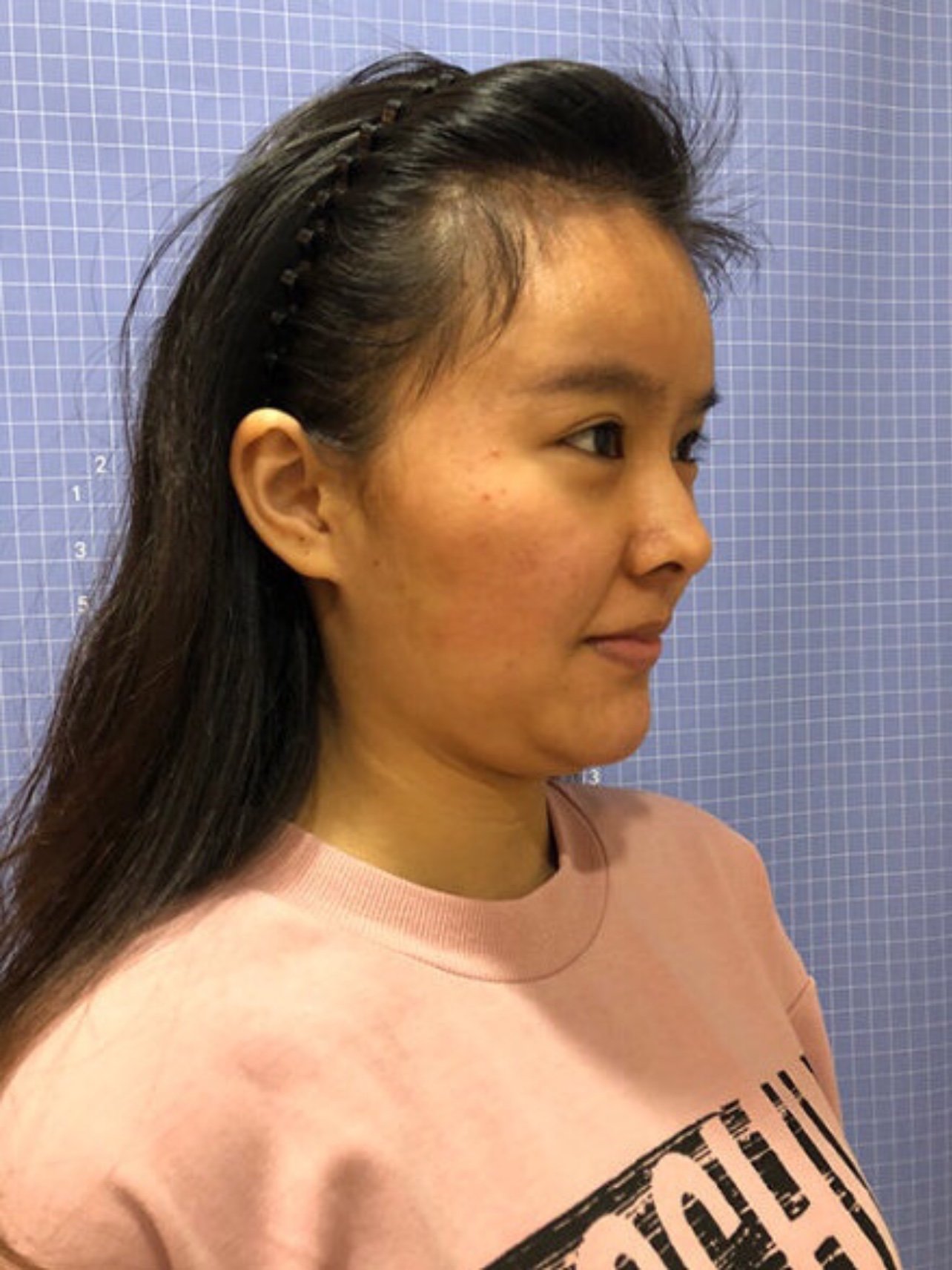 做完火凤凰的好处就是脸瘦了,脸颊上嘟嘟肉没有了.