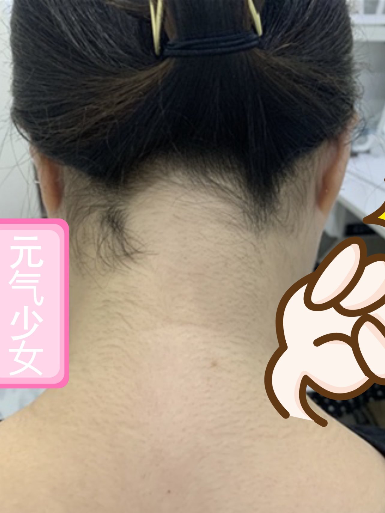 无额外费用,服务体验很棒今天去脱的是后发际线,有点_圈子-新氧美容