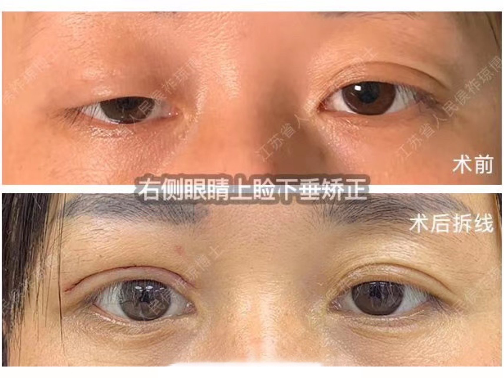 如果有上睑下垂,但做双眼皮的时候没有矫正,效果就会像图中案例顾客