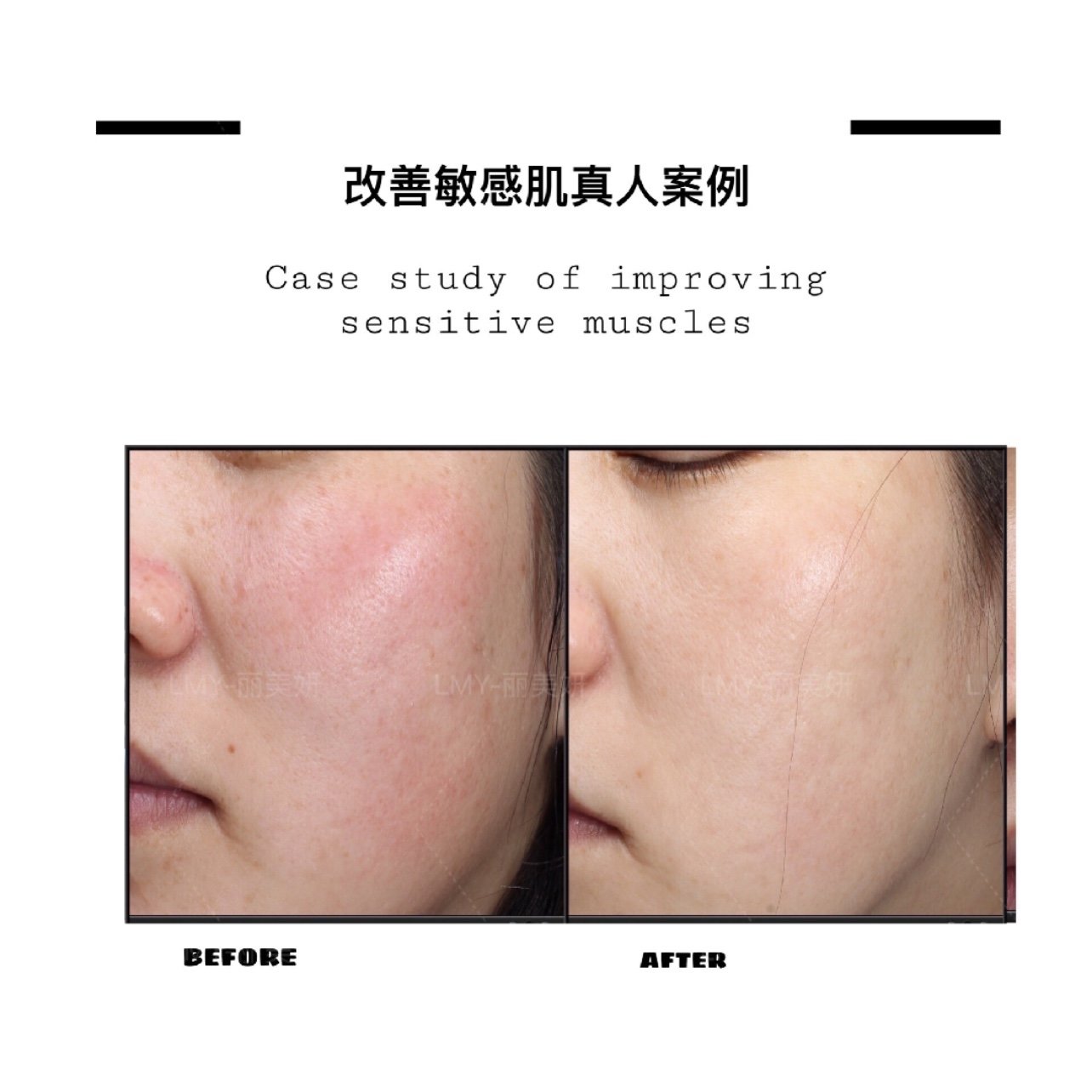 赛诺秀icon光子嫩肤改善敏感肌效果图