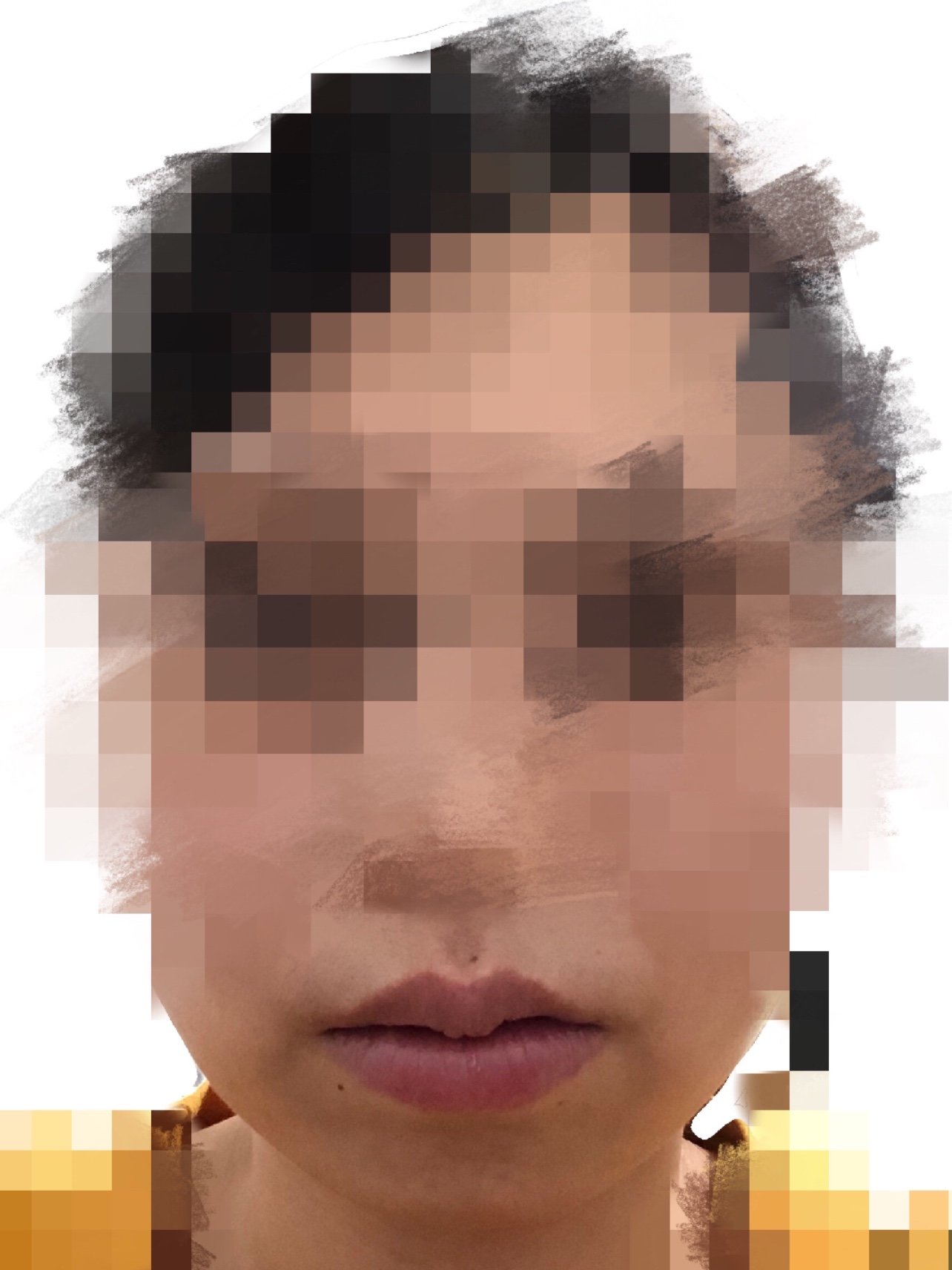 现在已经手术40多天,嘴巴还是歪的不对称,形状奇形_圈子-新氧美容整形